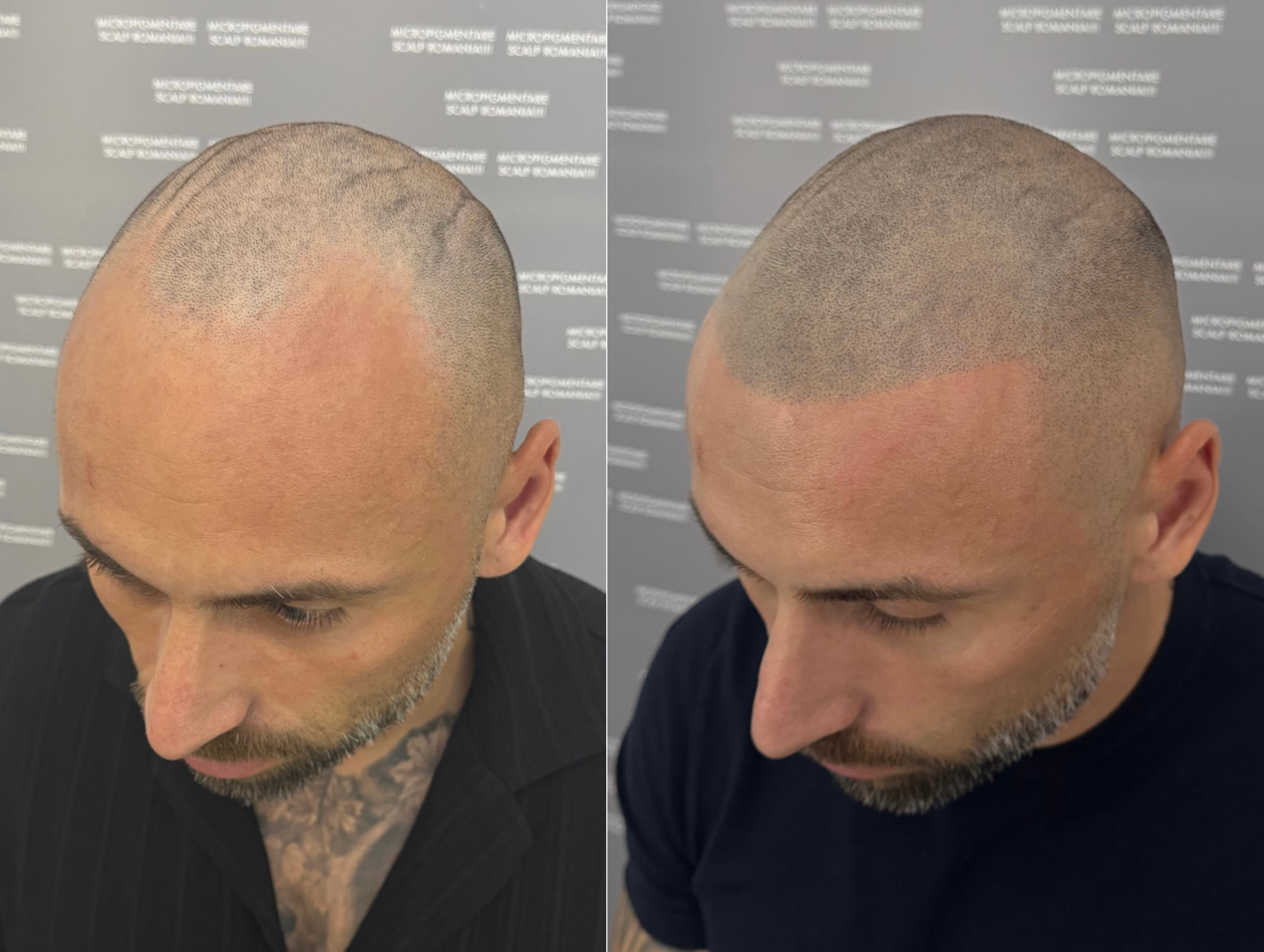 Perspectivă micropigmentare scalp - Alopecie Androgenetică