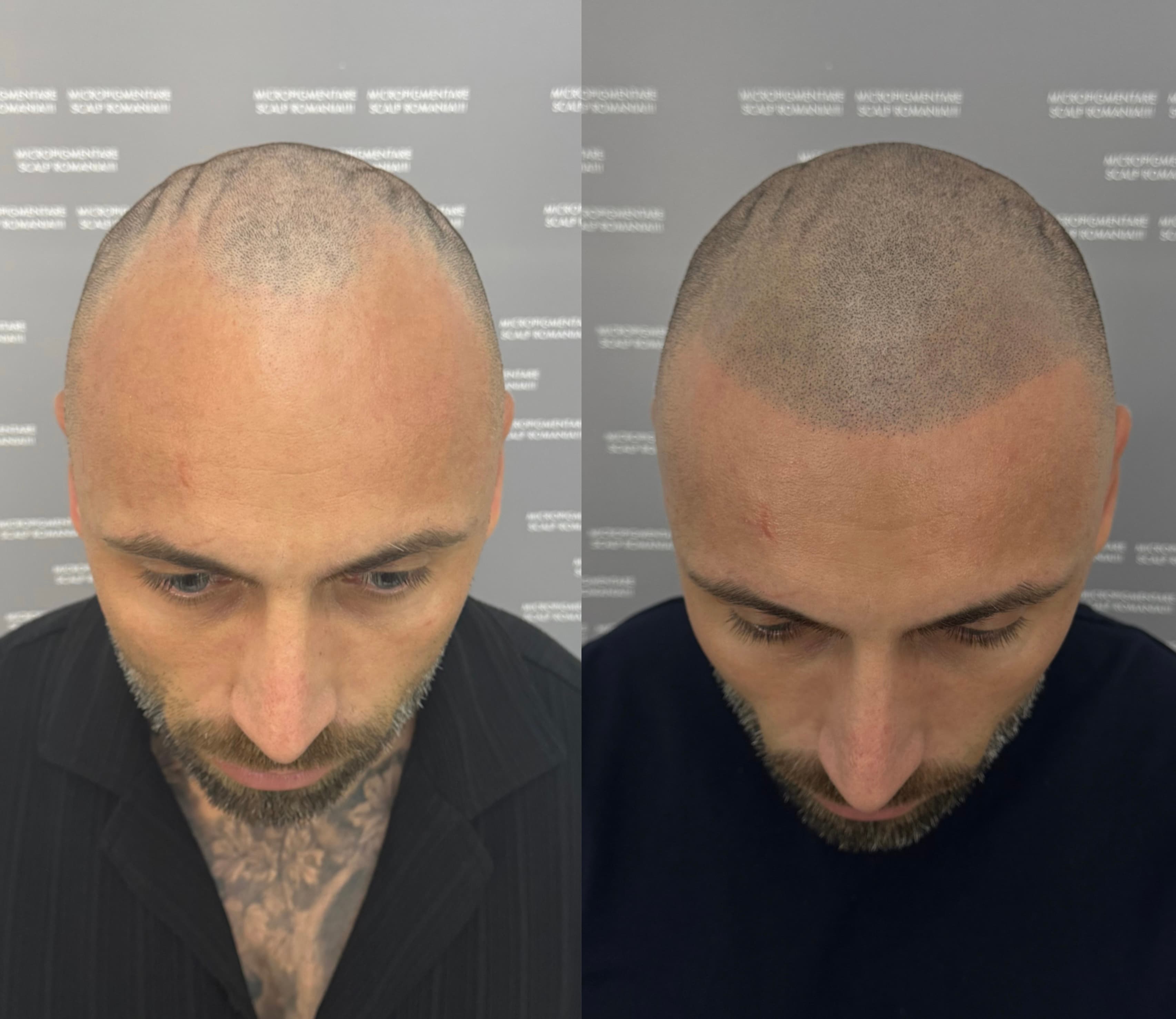 Perspectivă micropigmentare scalp - Alopecie Androgenetică