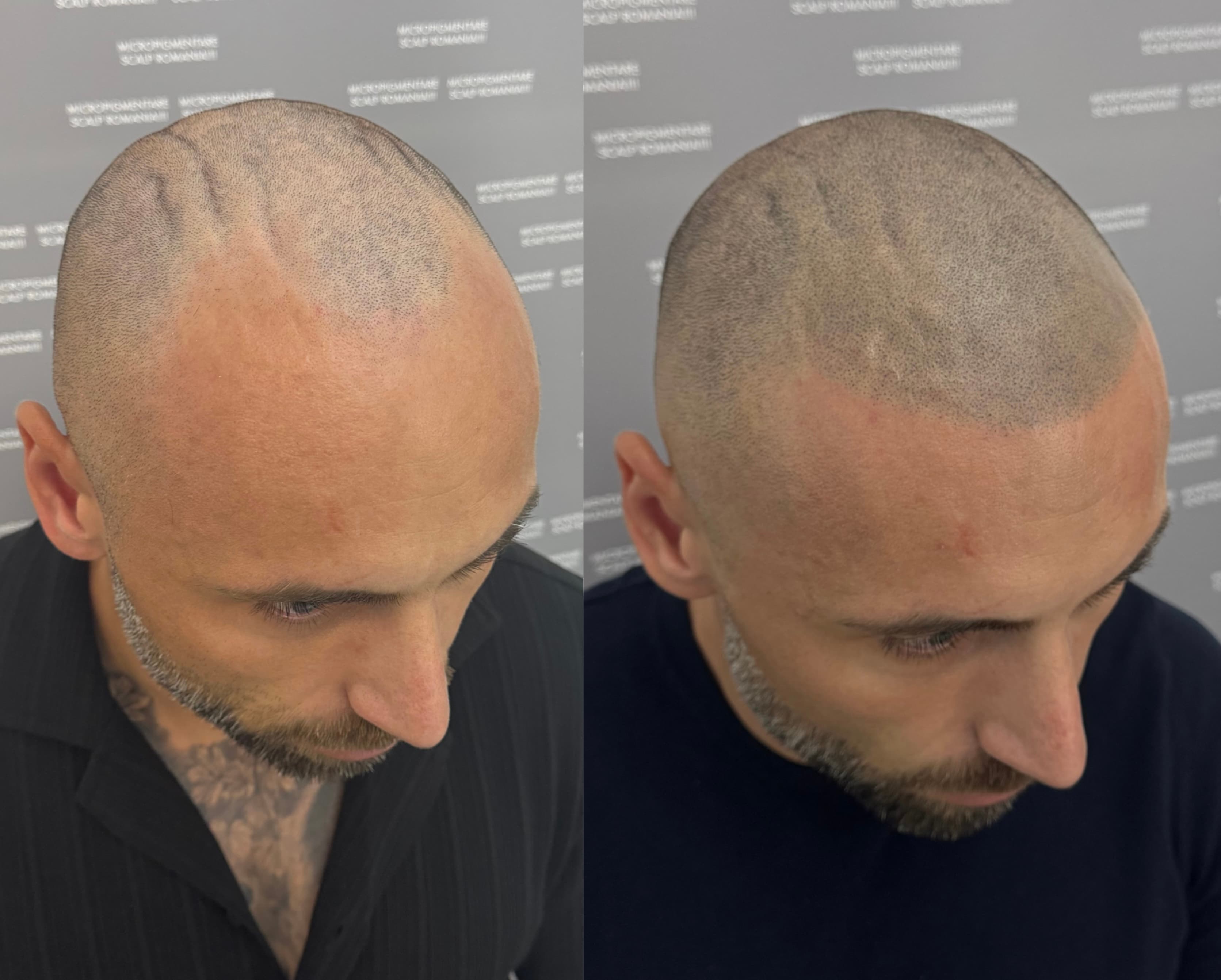 Perspectivă micropigmentare scalp - Alopecie Androgenetică