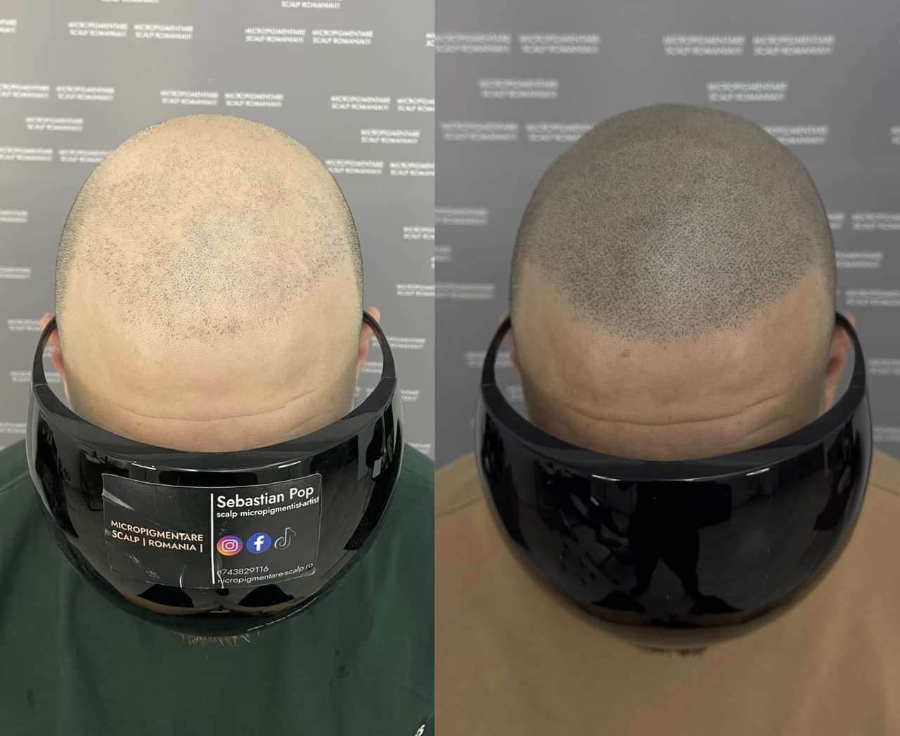 Perspectivă micropigmentare scalp - Densitate Post Transplant