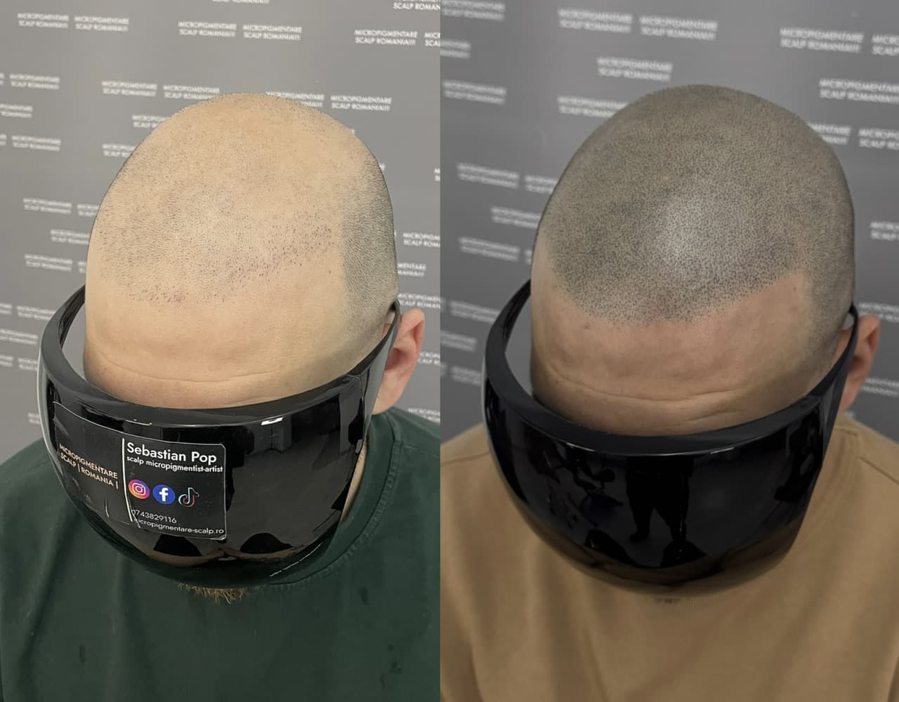 Perspectivă micropigmentare scalp - Densitate Post Transplant
