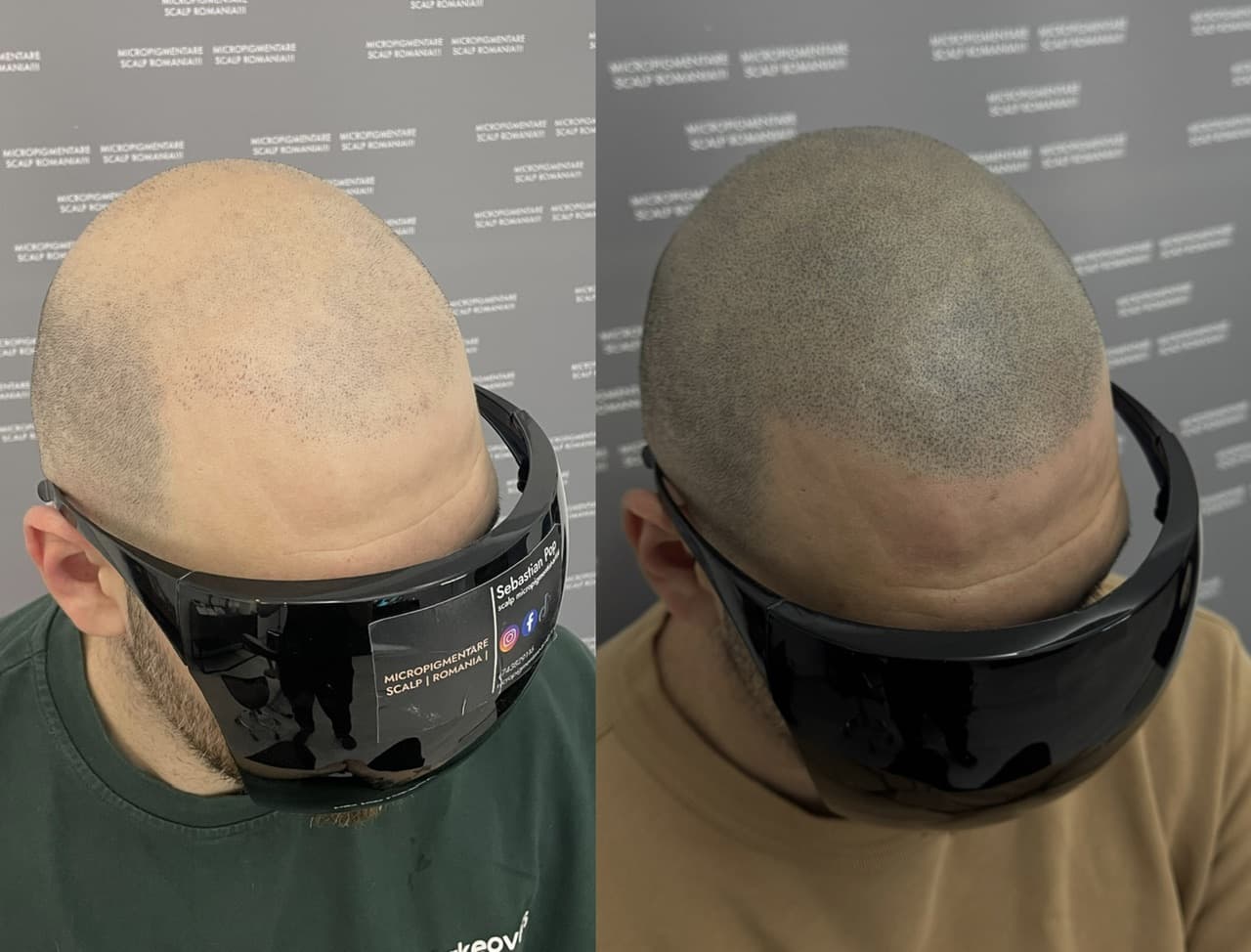 Perspectivă micropigmentare scalp - Densitate Post Transplant