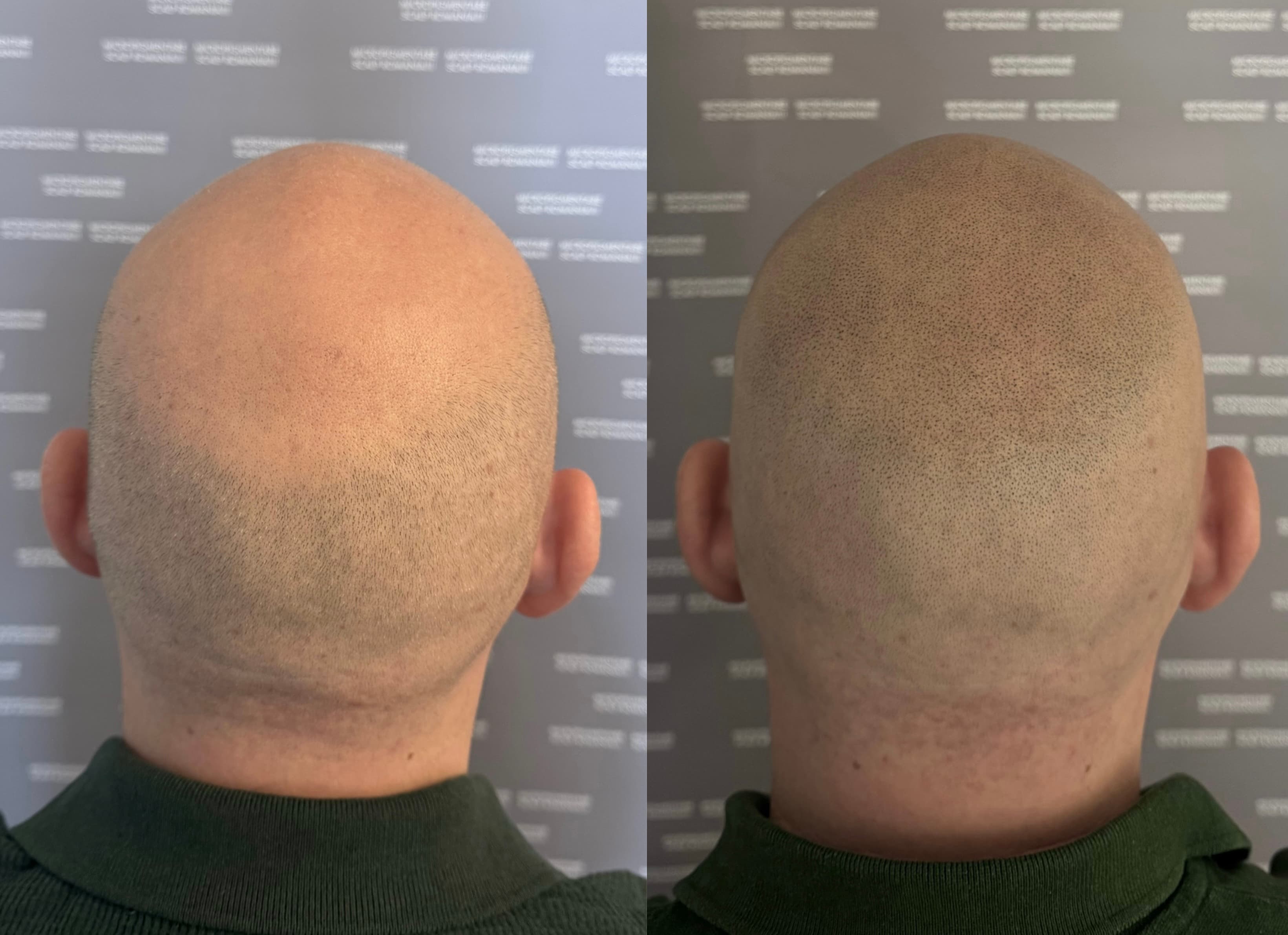 Perspectivă micropigmentare scalp - Alopecie Androgenetică