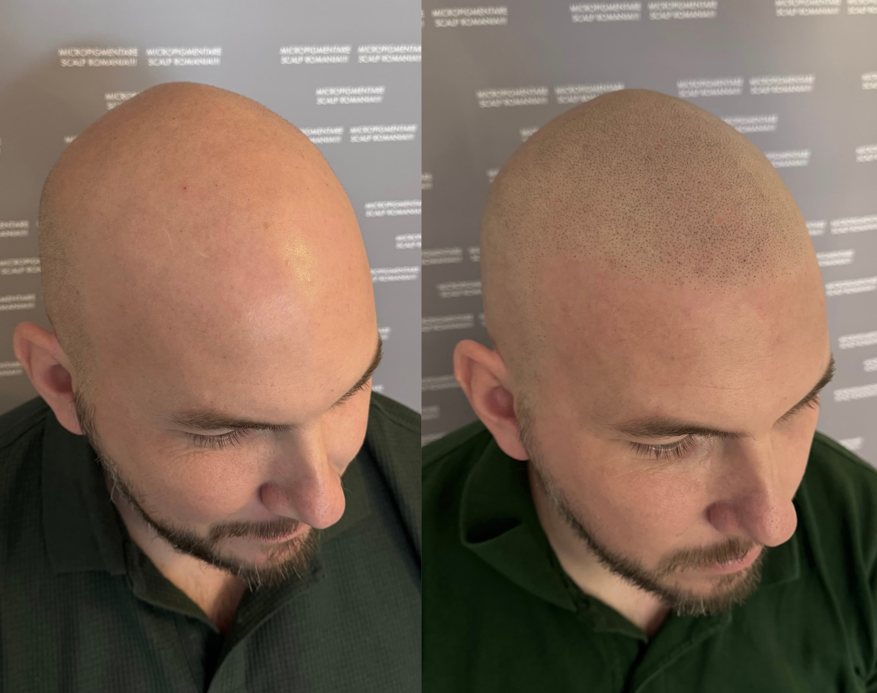 Perspectivă micropigmentare scalp - Alopecie Androgenetică
