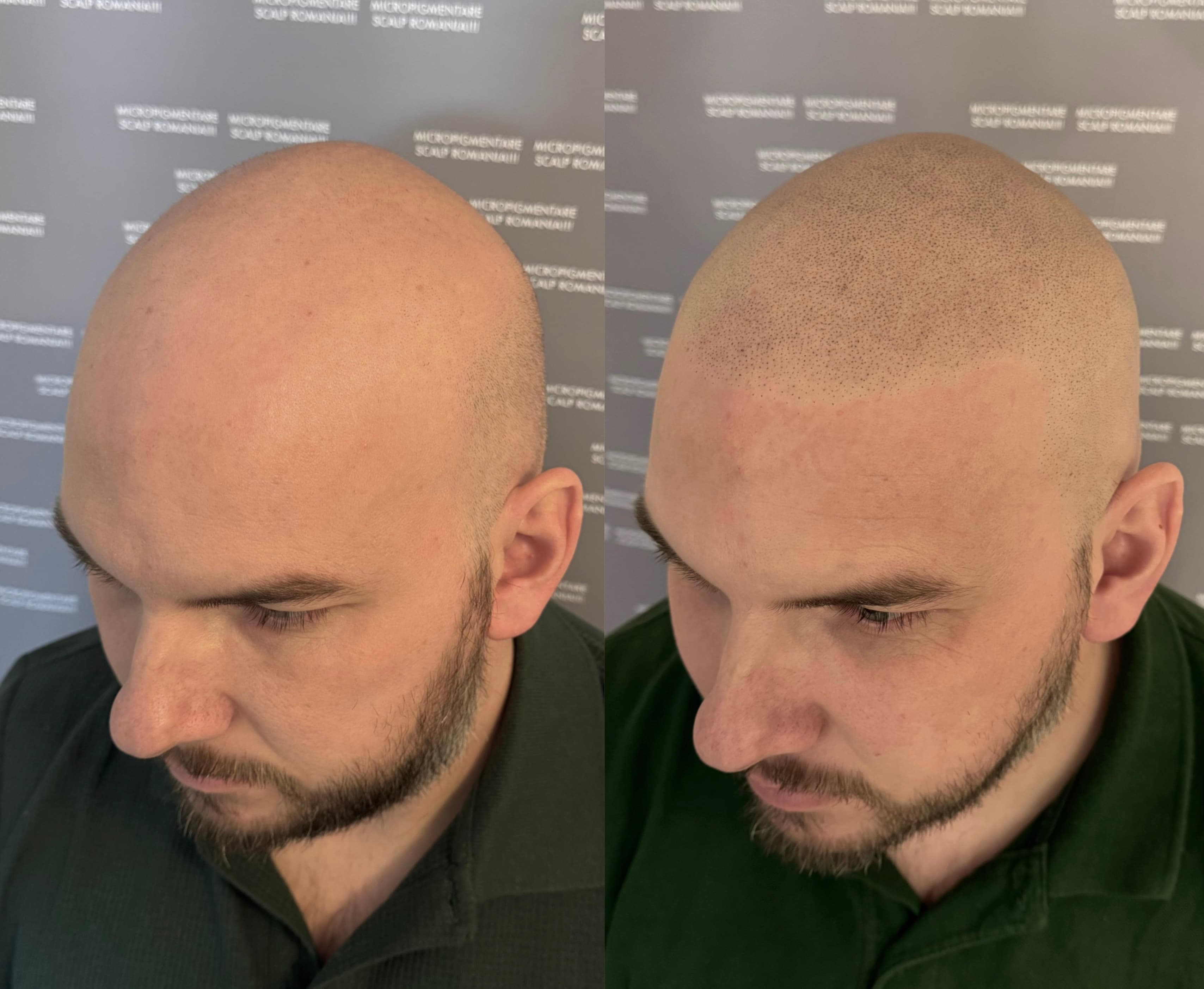 Perspectivă micropigmentare scalp - Alopecie Androgenetică