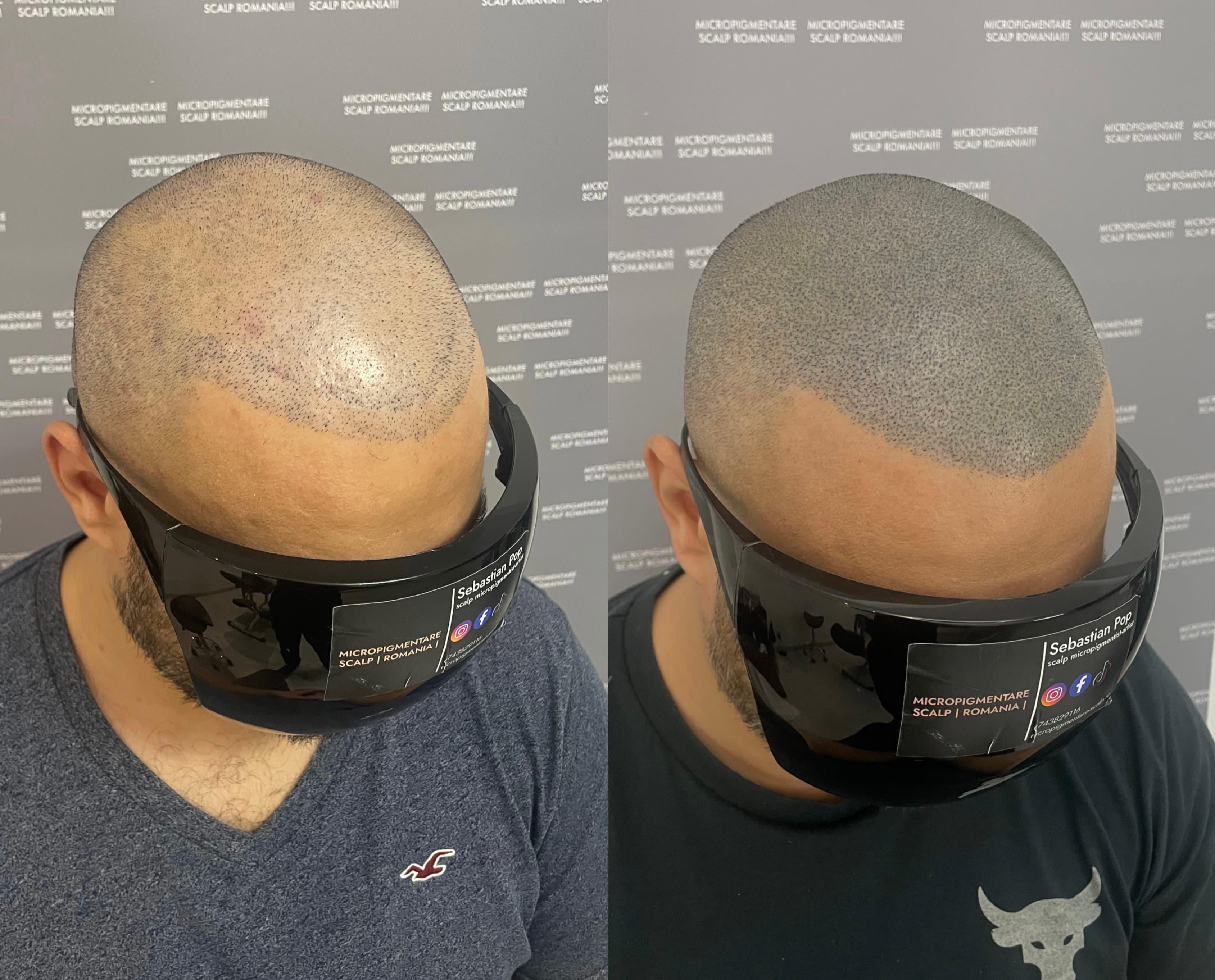 Perspectivă micropigmentare scalp - Densitate Post Transplant