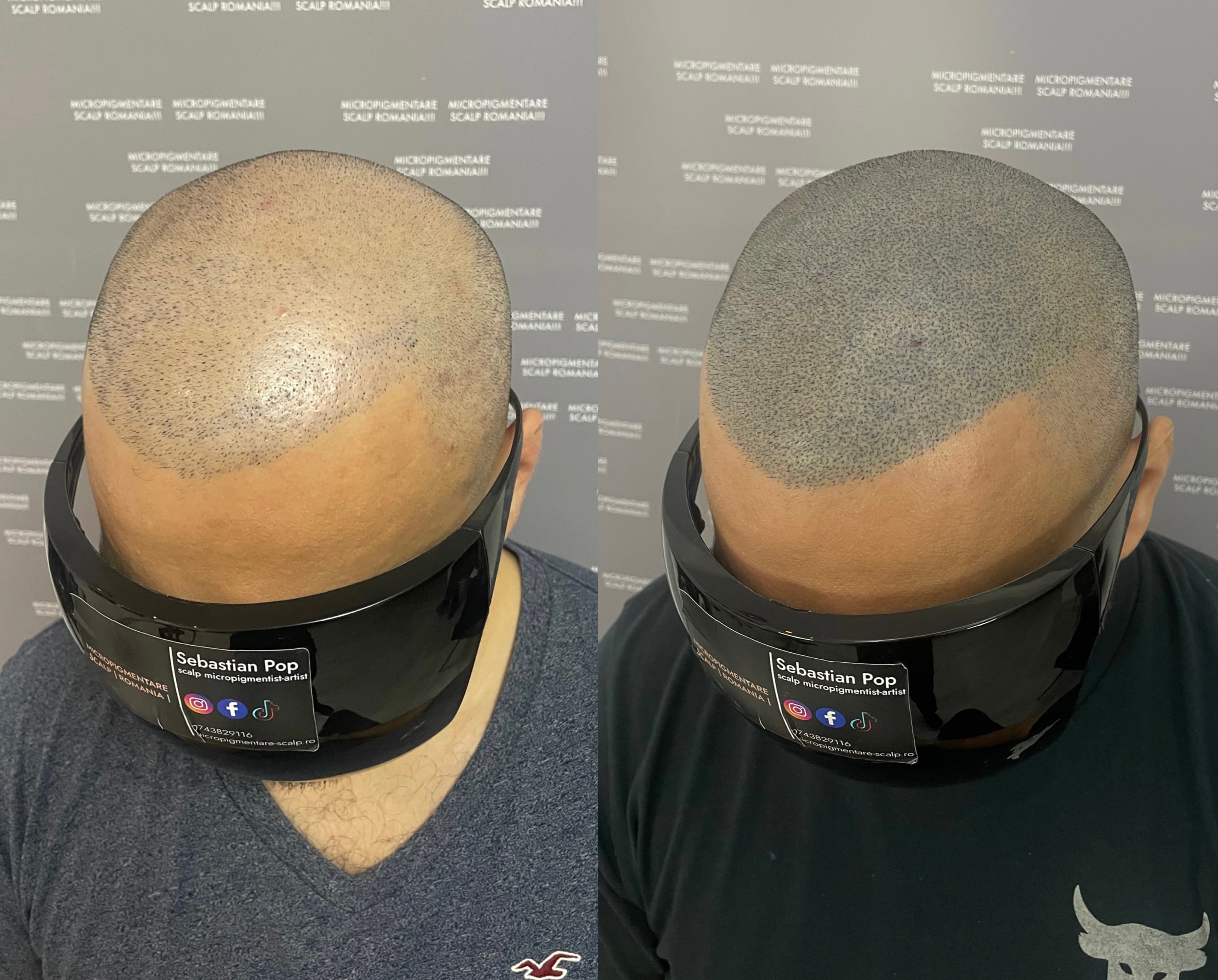Perspectivă micropigmentare scalp - Densitate Post Transplant