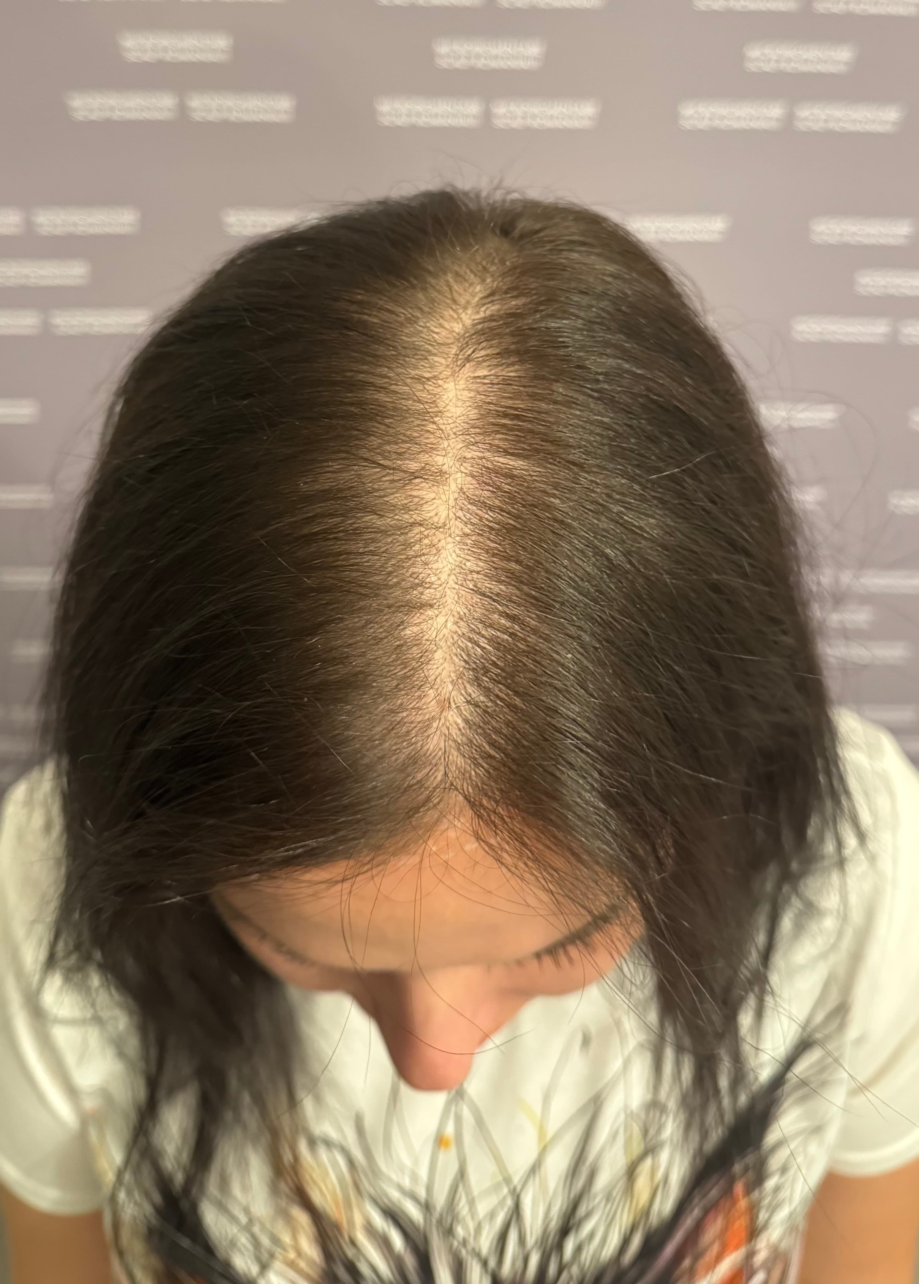 Perspectivă micropigmentare scalp - Micropigmentare Scalp Femei