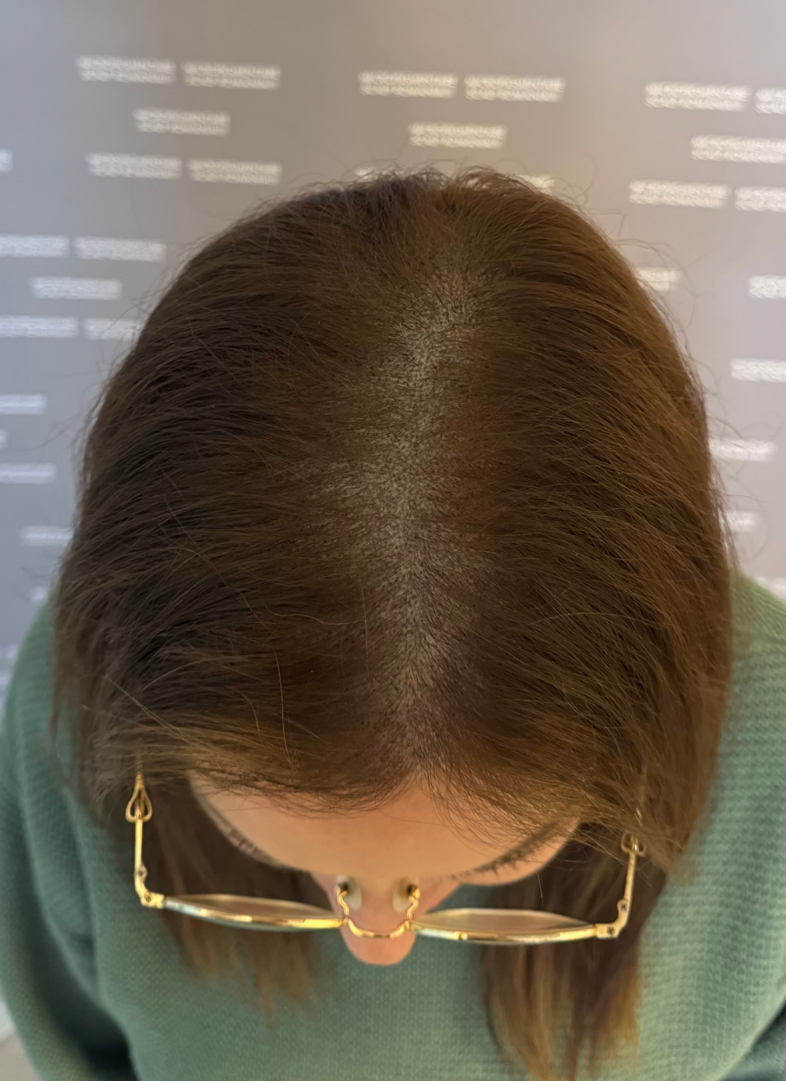 Perspectivă micropigmentare scalp - Micropigmentare Scalp Femei