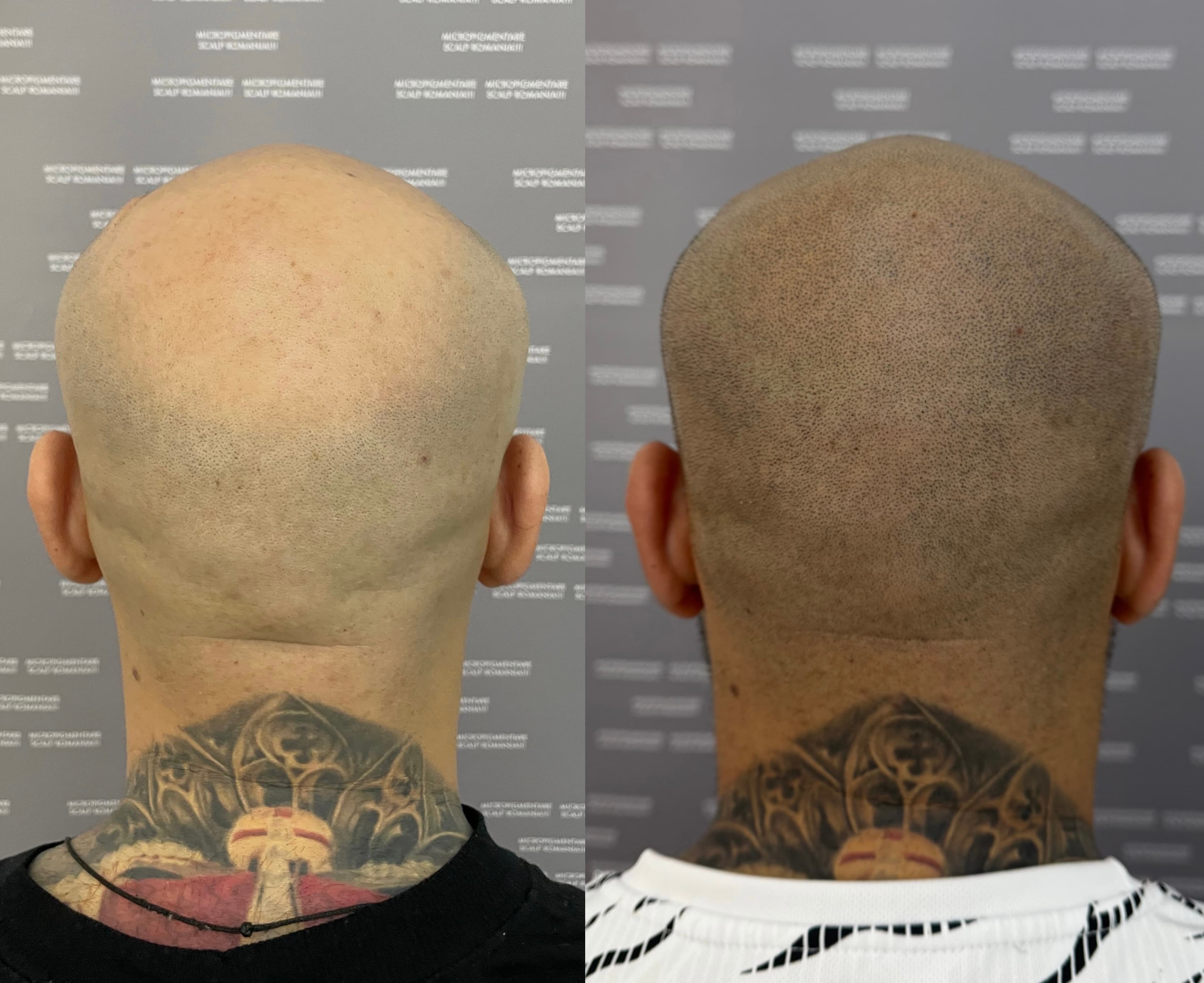 Perspectivă micropigmentare scalp - Alopecie Androgenetică