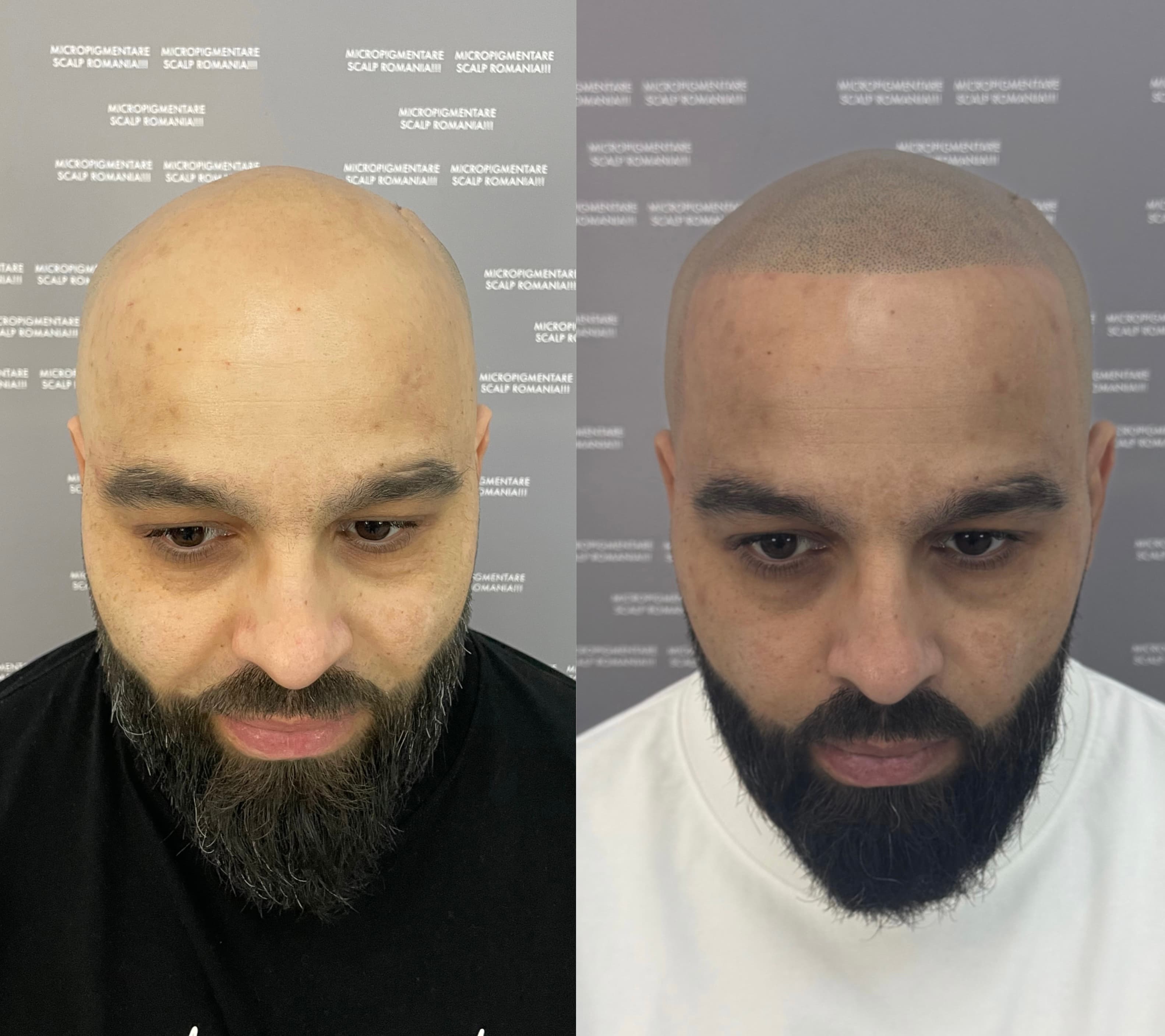 Perspectivă micropigmentare scalp - Alopecie Androgenetică