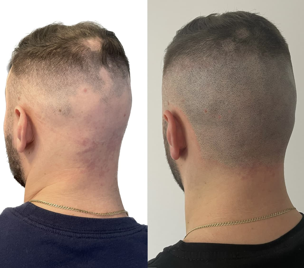 Perspectivă micropigmentare scalp - Alopecie Areată