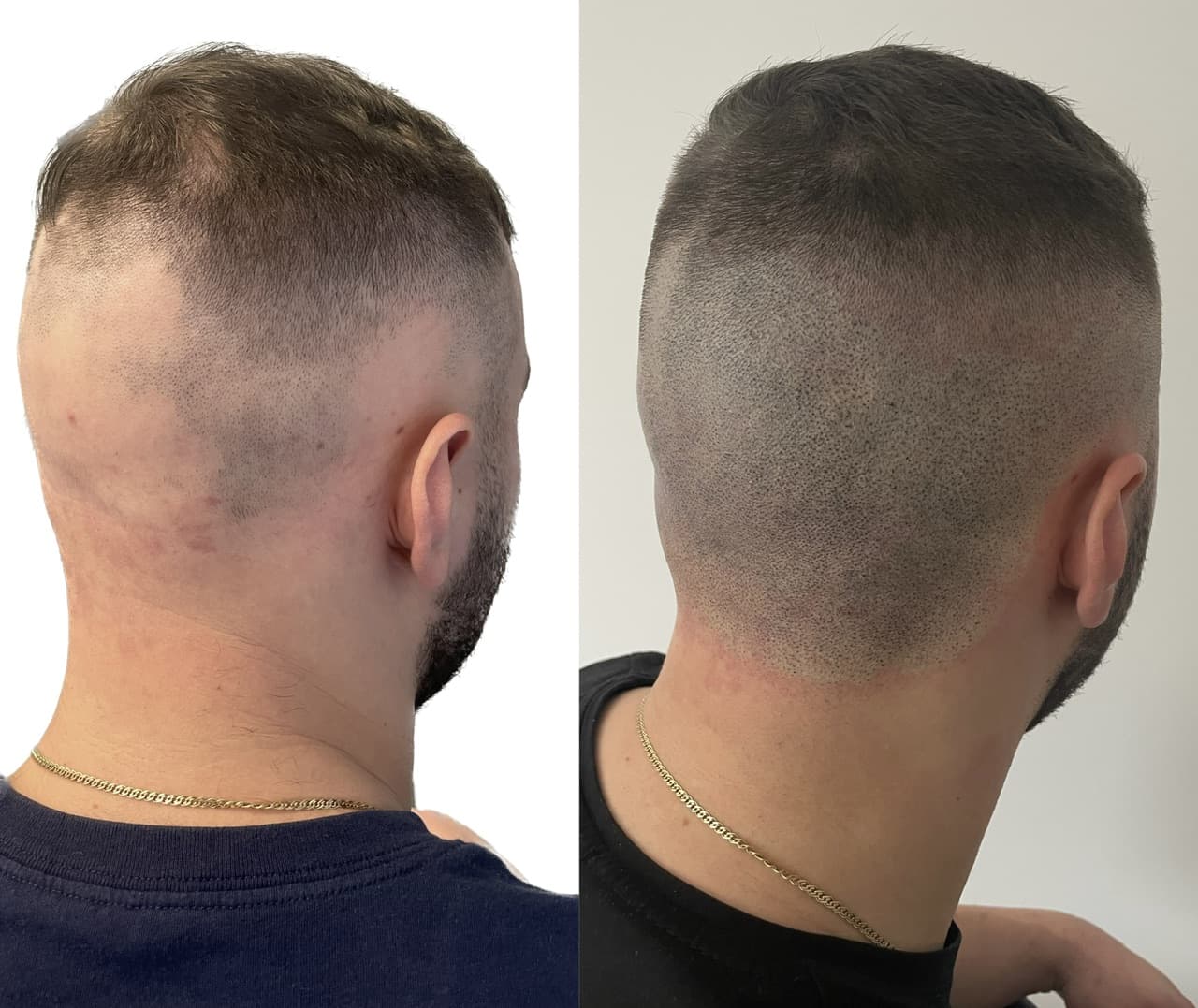 Perspectivă micropigmentare scalp - Alopecie Areată