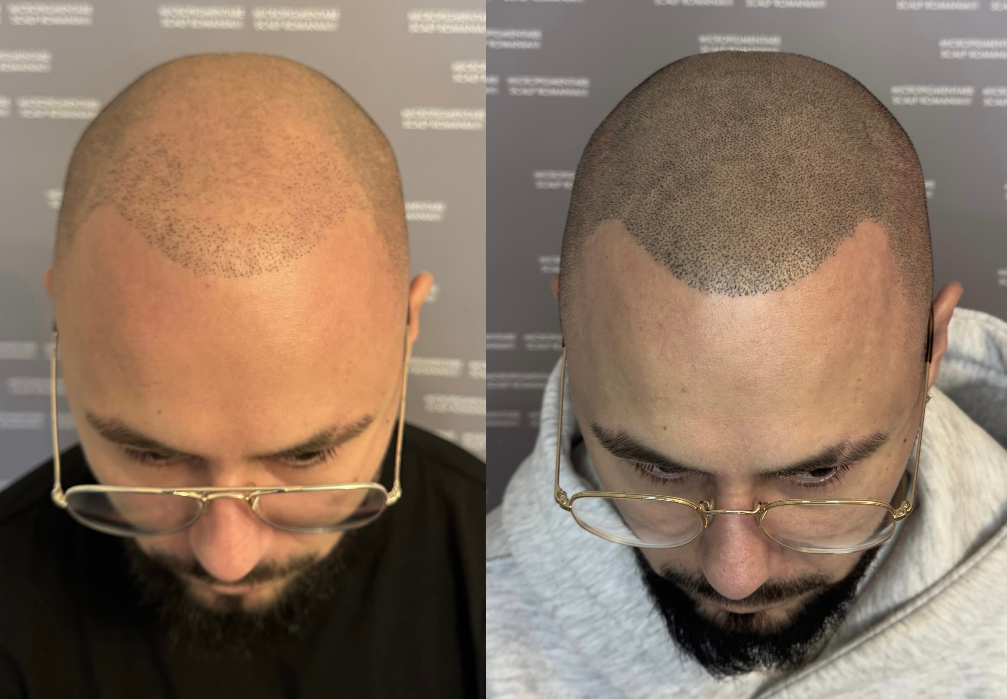 Perspectivă micropigmentare scalp - Densitate Post Transplant