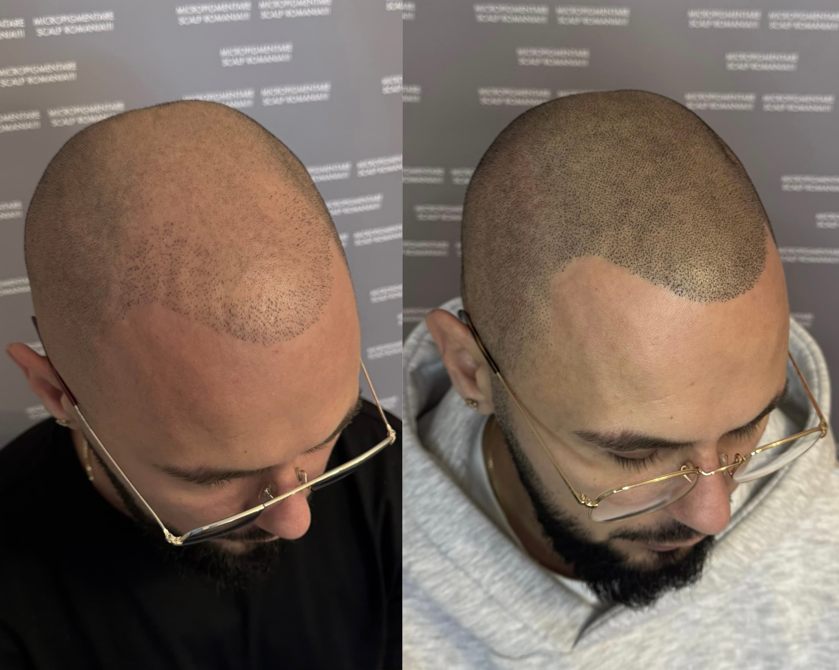 Perspectivă micropigmentare scalp - Densitate Post Transplant