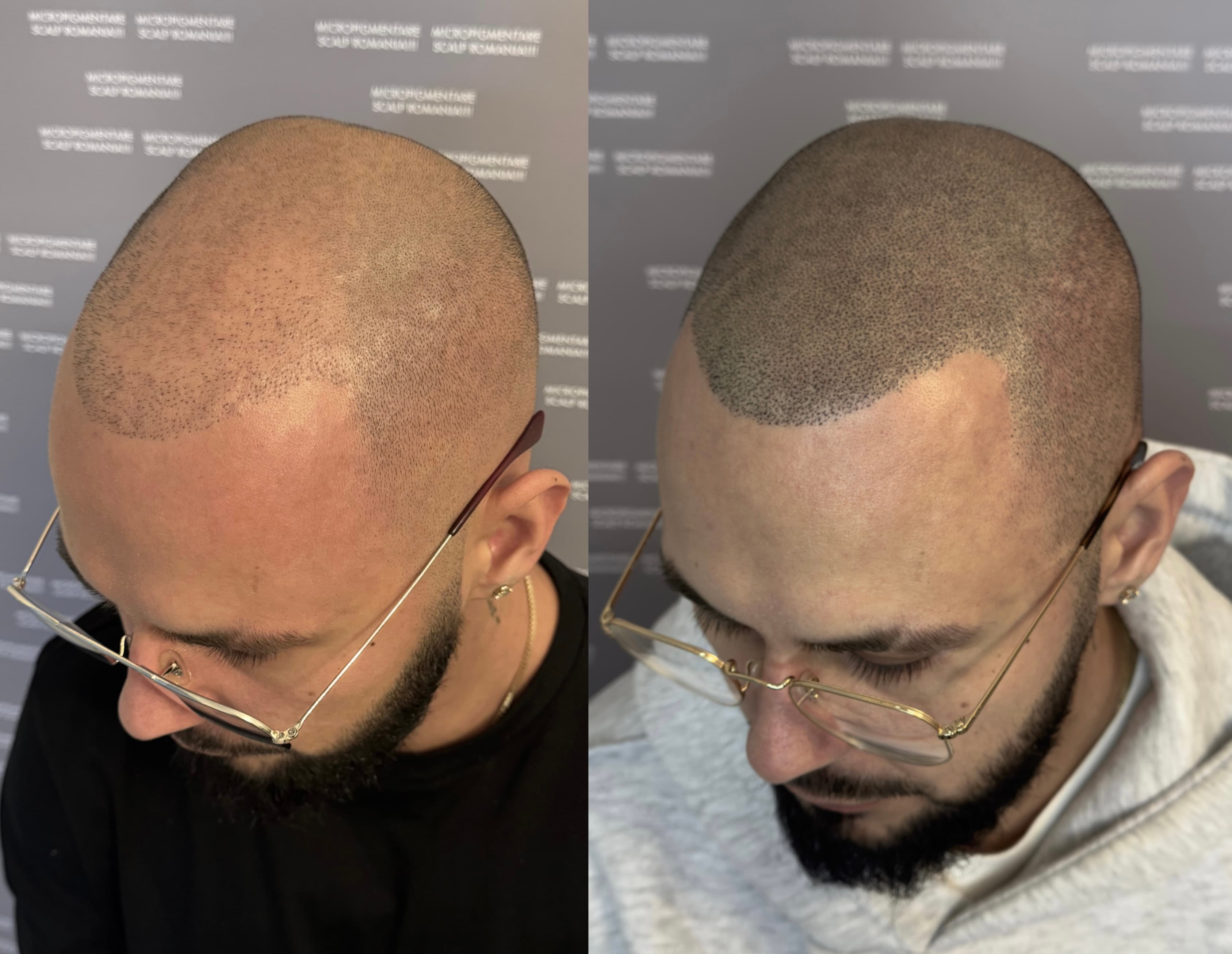 Perspectivă micropigmentare scalp - Densitate Post Transplant