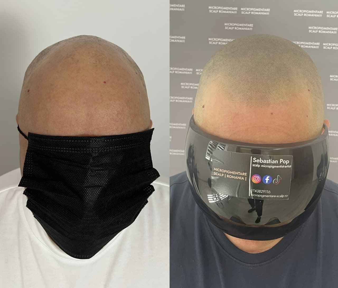 Perspectivă micropigmentare scalp - Alopecie Areată