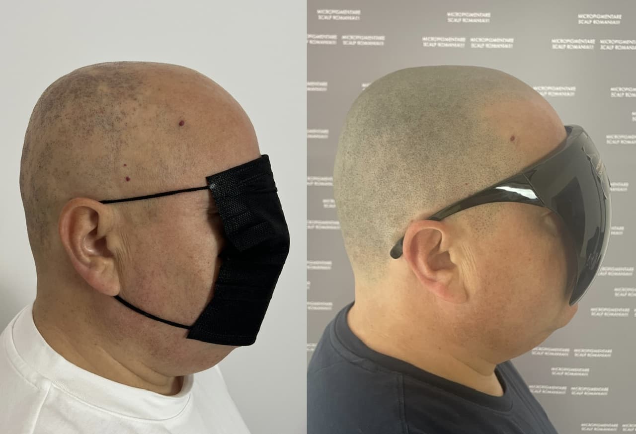 Perspectivă micropigmentare scalp - Alopecie Areată