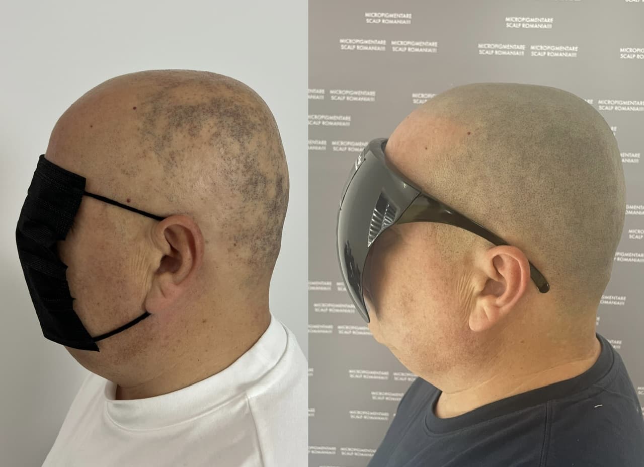 Perspectivă micropigmentare scalp - Alopecie Areată