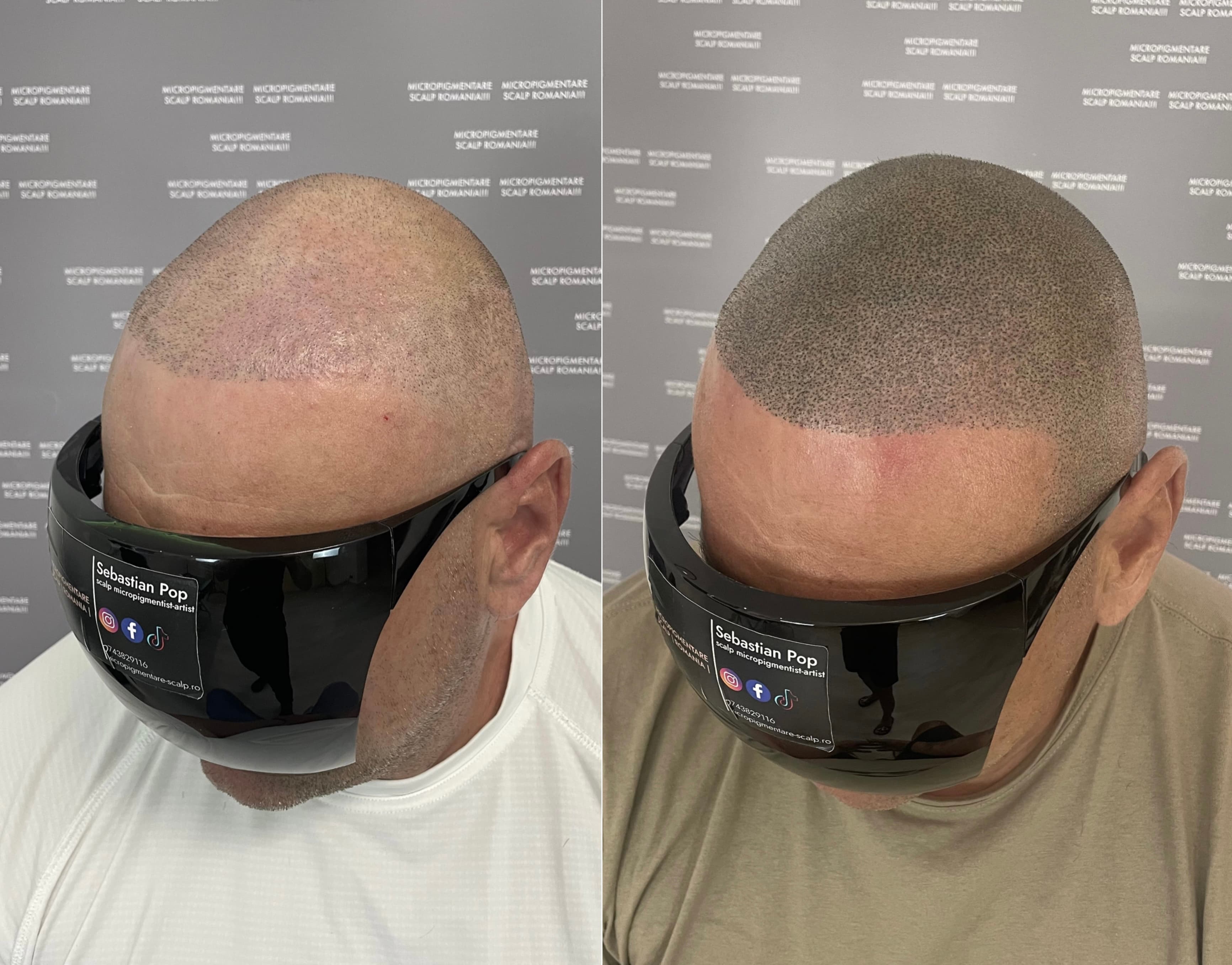 Perspectivă micropigmentare scalp - Densitate Post Transplant