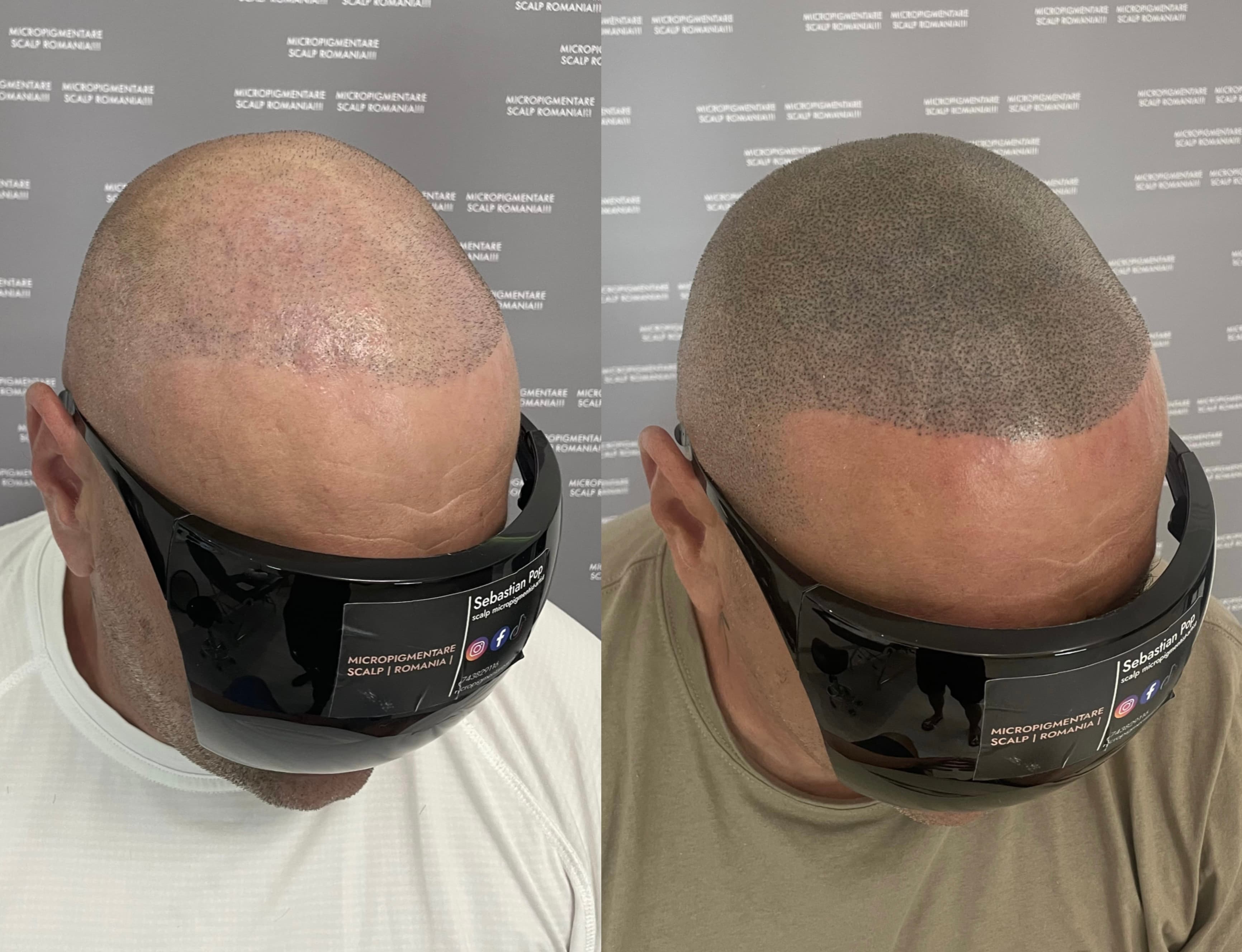 Perspectivă micropigmentare scalp - Densitate Post Transplant
