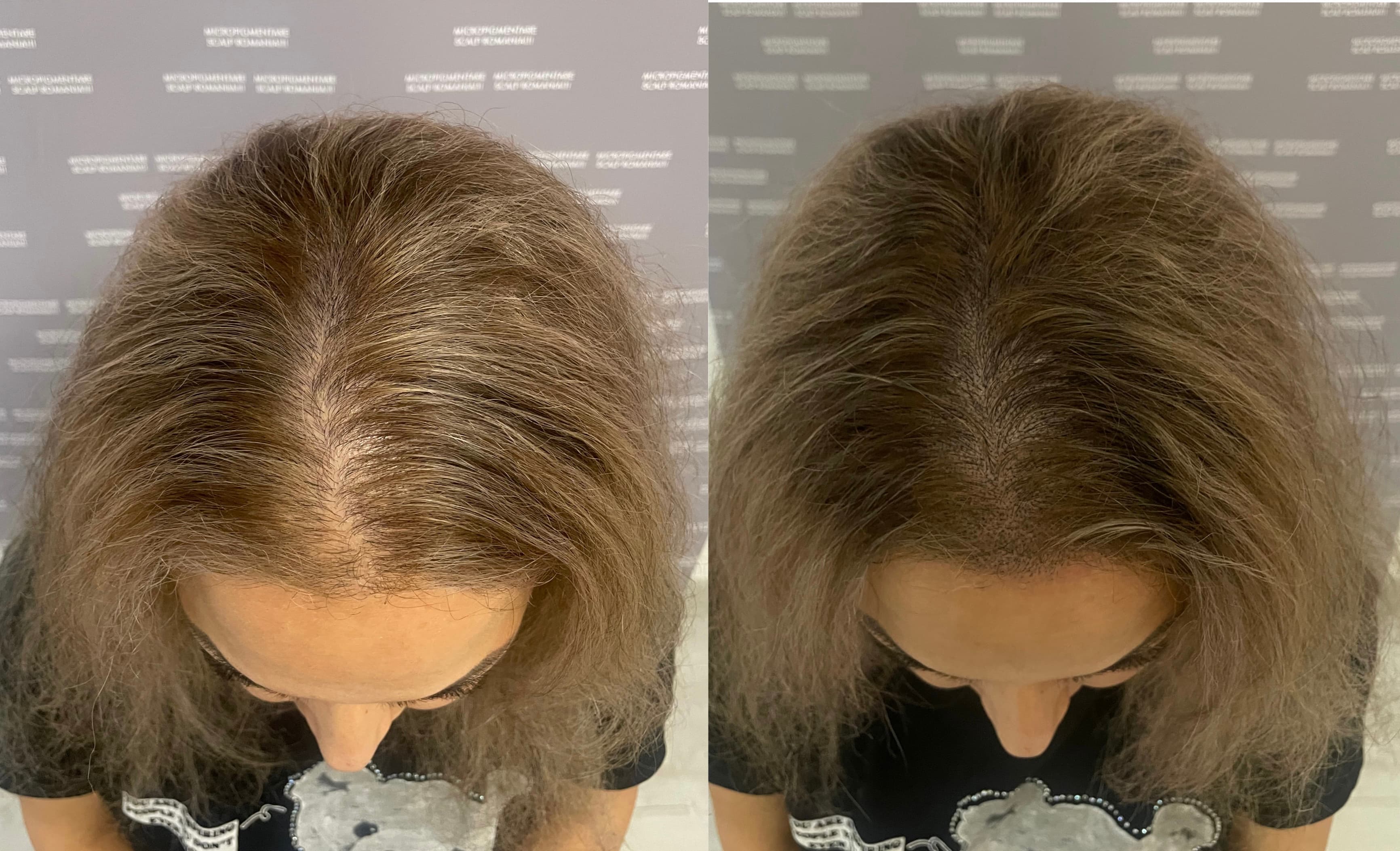 Perspectivă micropigmentare scalp - Micropigmentare Scalp Femei