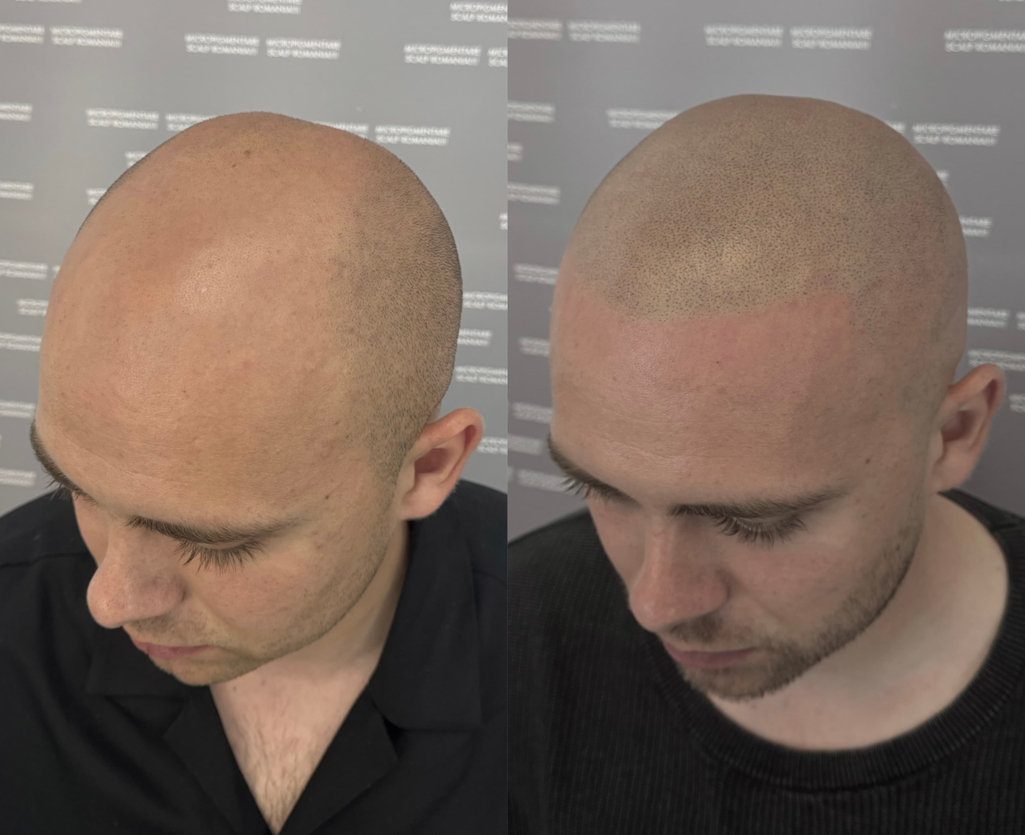 Perspectivă micropigmentare scalp - Alopecie Androgenetică
