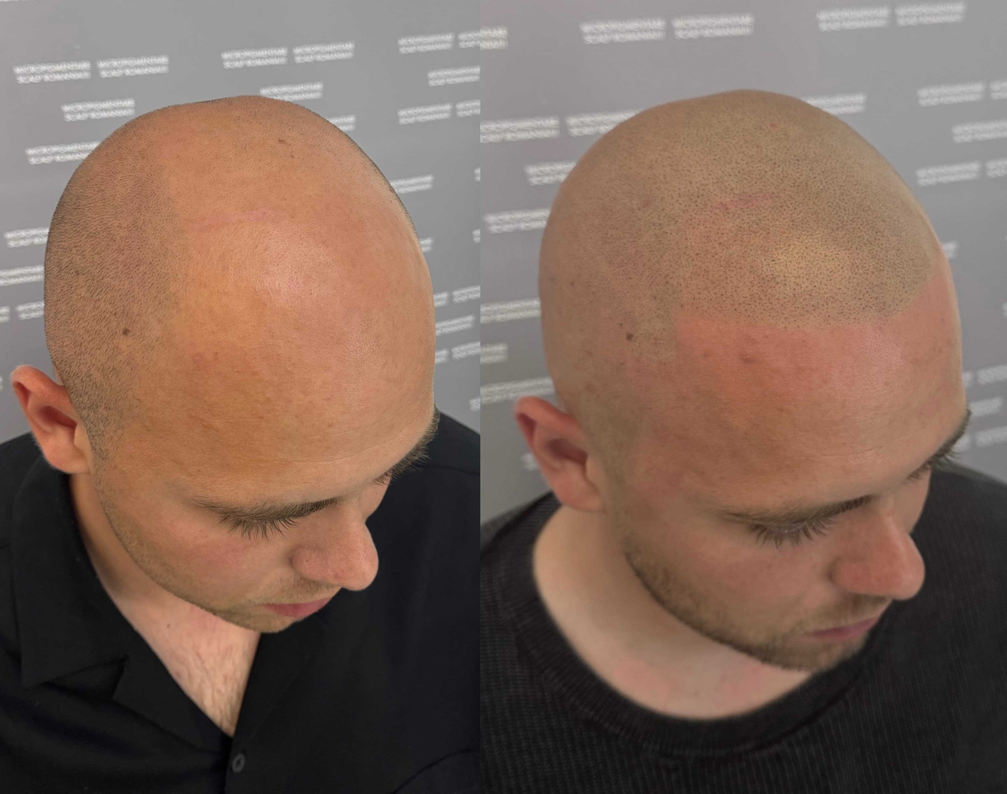 Perspectivă micropigmentare scalp - Alopecie Androgenetică
