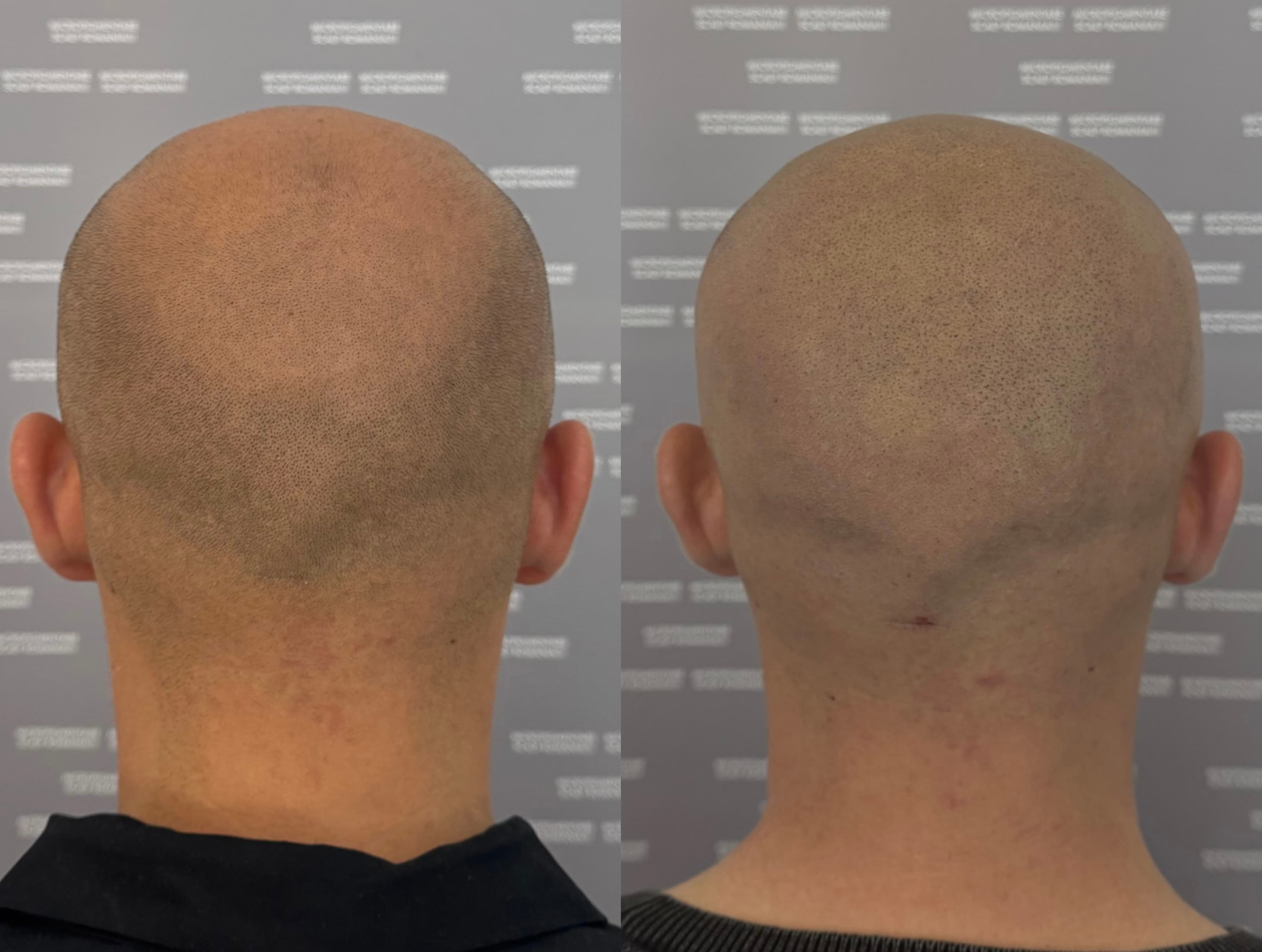 Perspectivă micropigmentare scalp - Alopecie Androgenetică