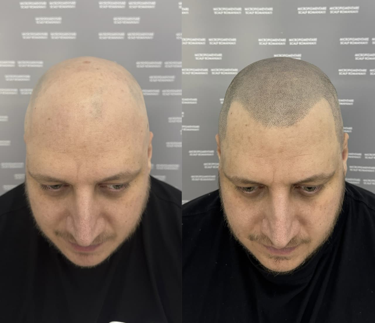 Perspectivă micropigmentare scalp - Alopecie Areată