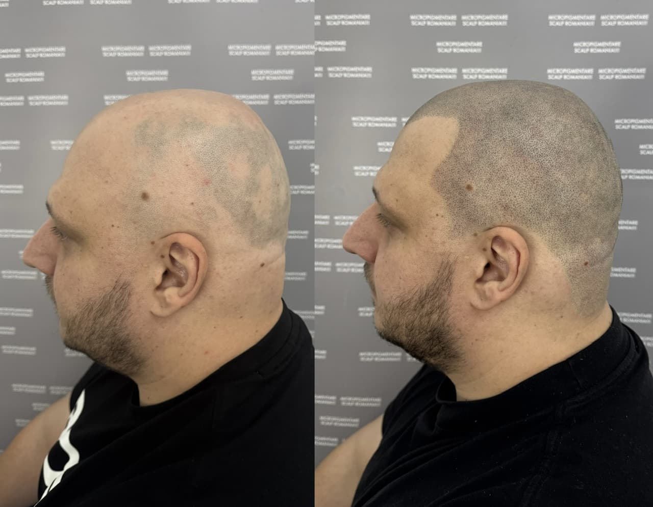 Perspectivă micropigmentare scalp - Alopecie Areată