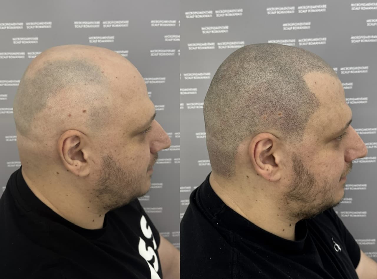 Perspectivă micropigmentare scalp - Alopecie Areată