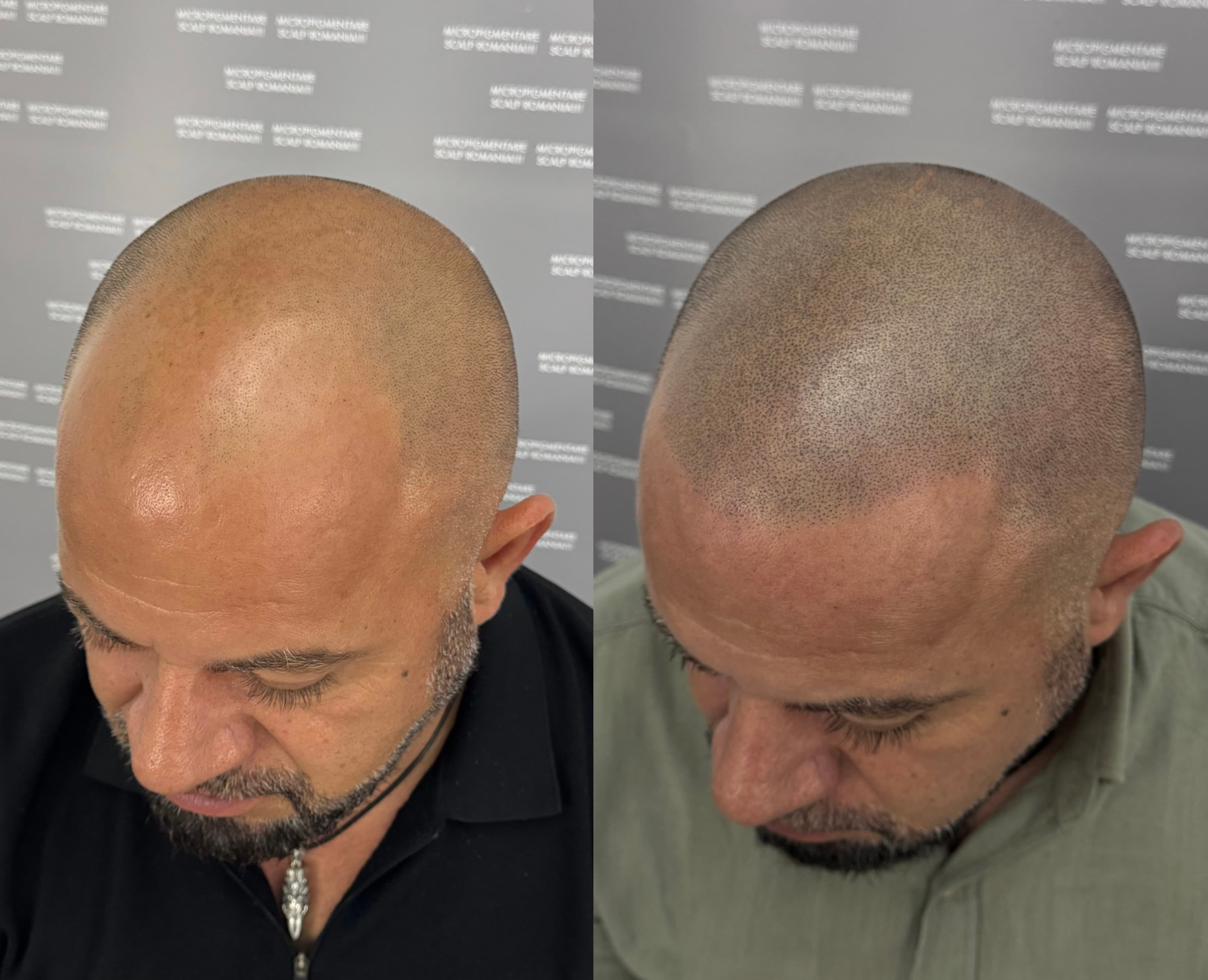 Perspectivă micropigmentare scalp - Alopecie Androgenetică