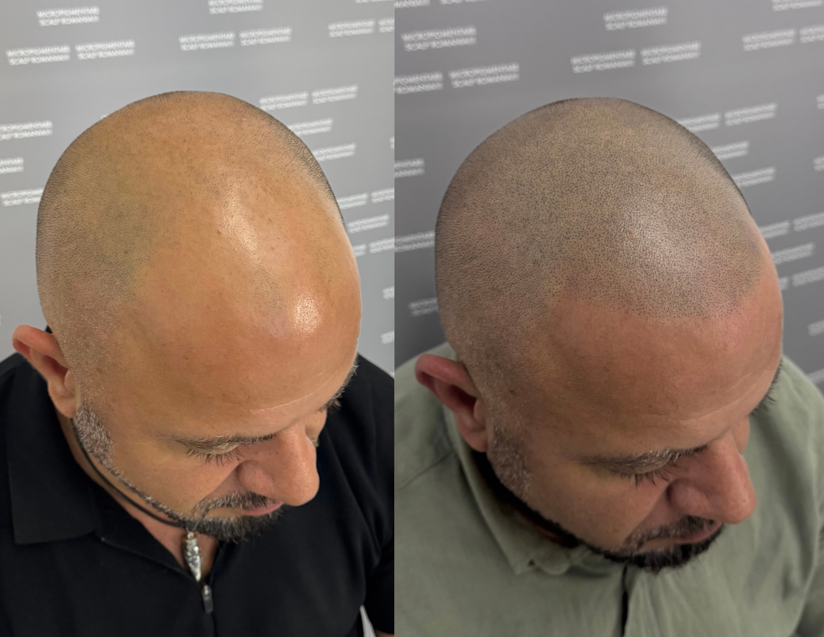 Perspectivă micropigmentare scalp - Alopecie Androgenetică