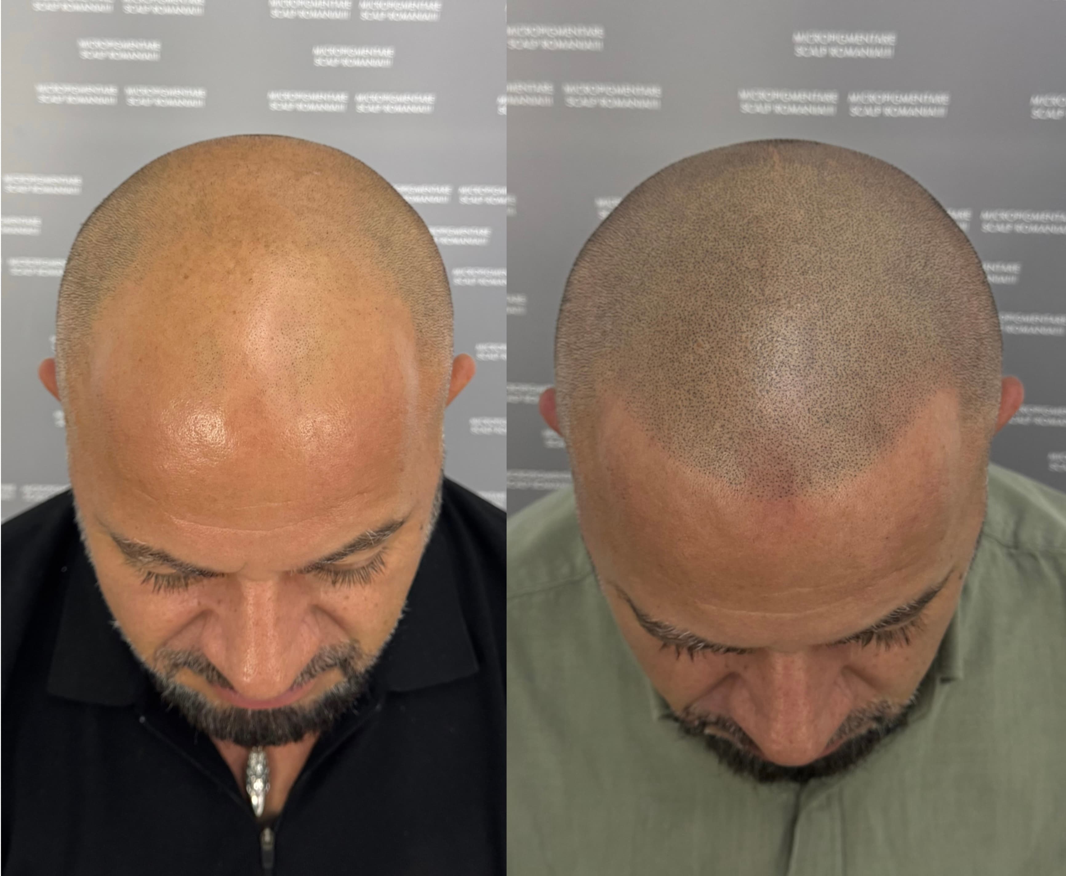 Perspectivă micropigmentare scalp - Alopecie Androgenetică
