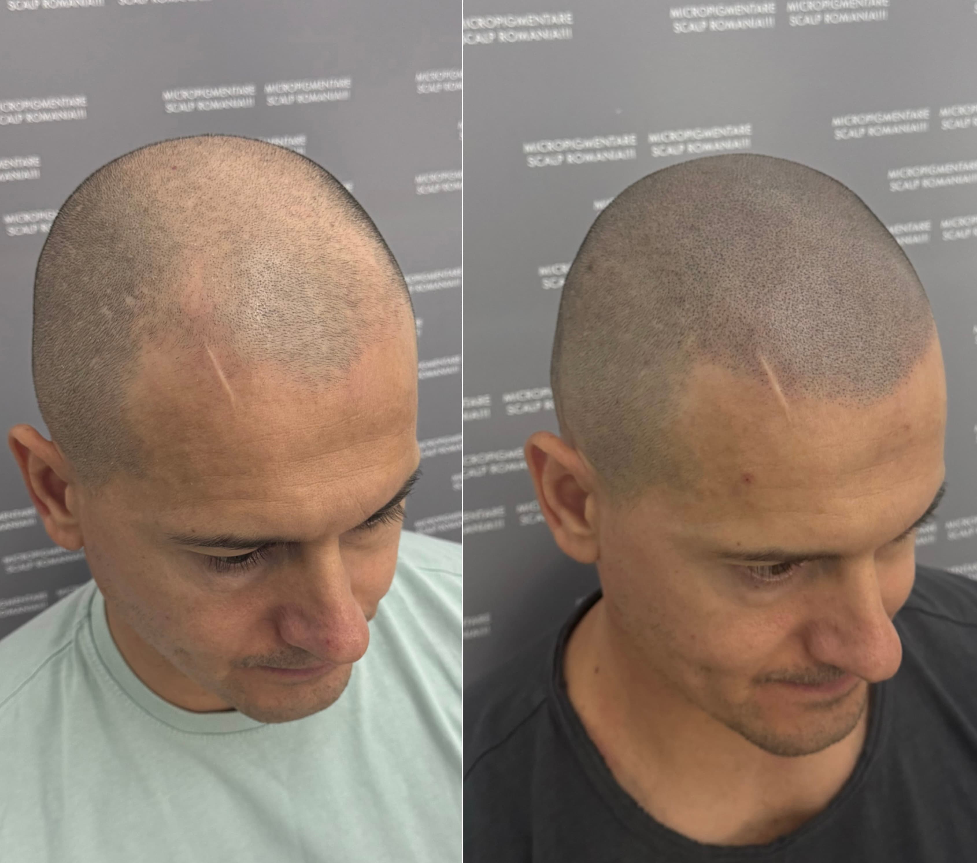 Perspectivă micropigmentare scalp - Alopecie Androgenetică