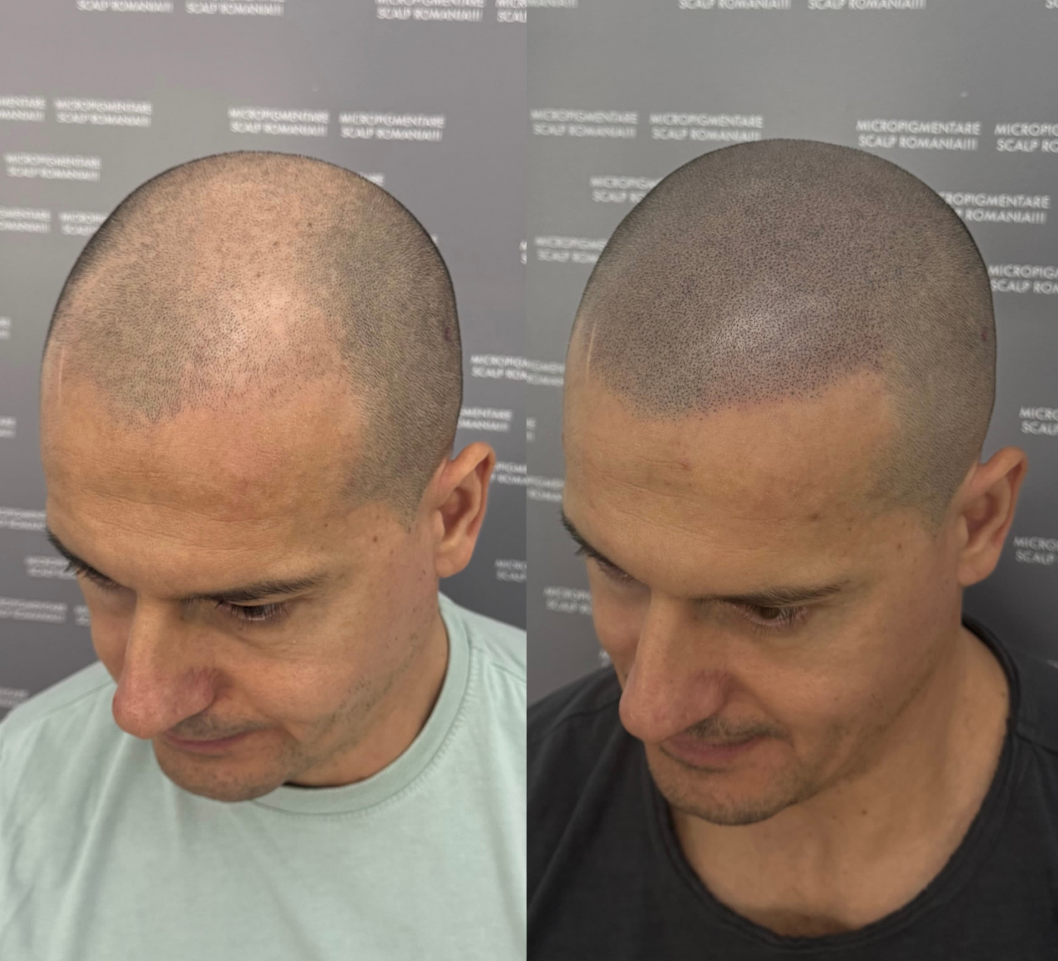 Perspectivă micropigmentare scalp - Alopecie Androgenetică