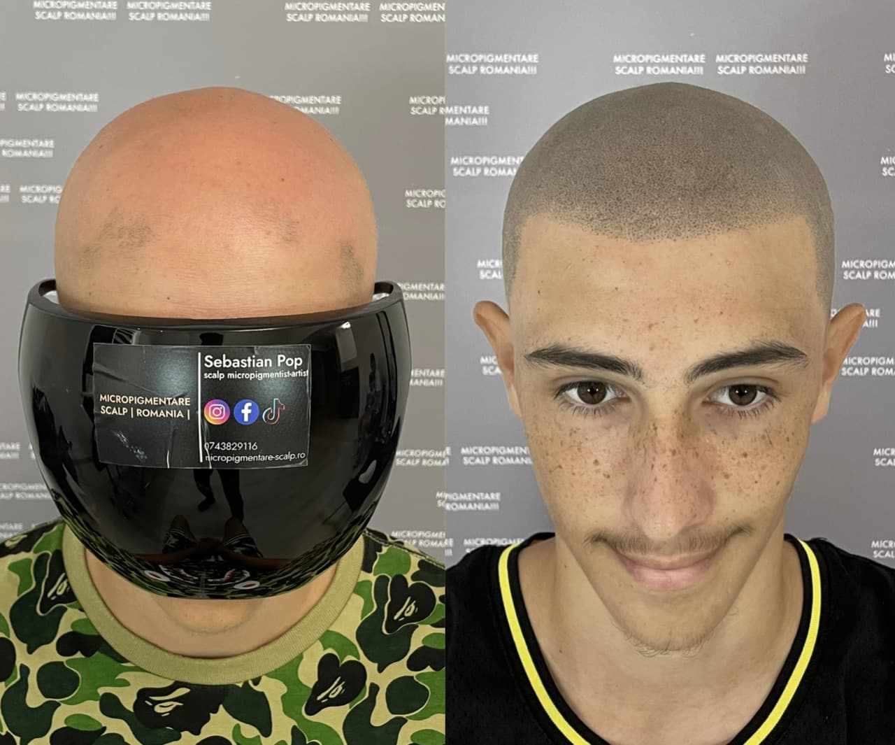 Perspectivă micropigmentare scalp - Alopecie Areată