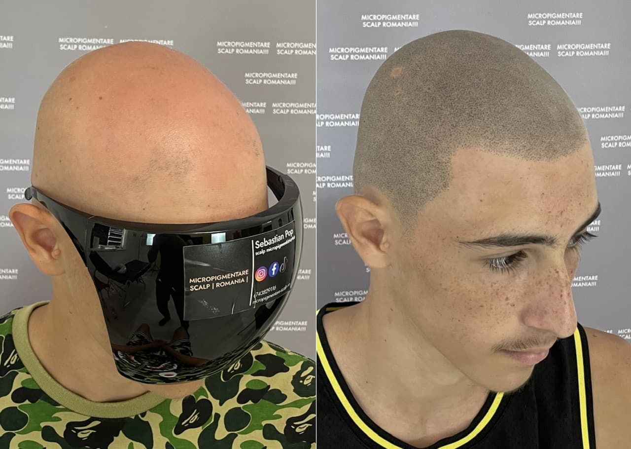 Perspectivă micropigmentare scalp - Alopecie Areată