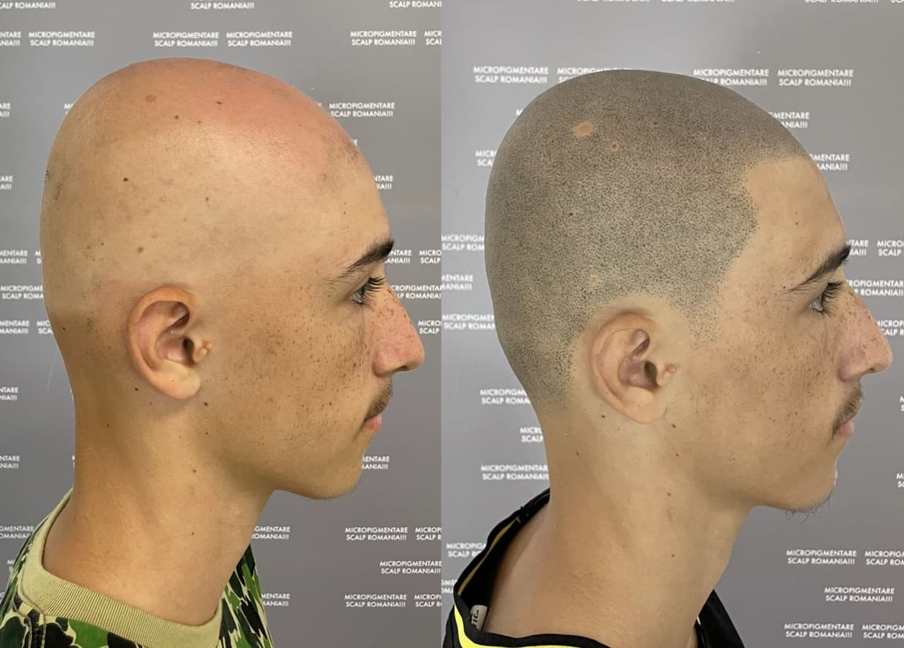 Perspectivă micropigmentare scalp - Alopecie Areată