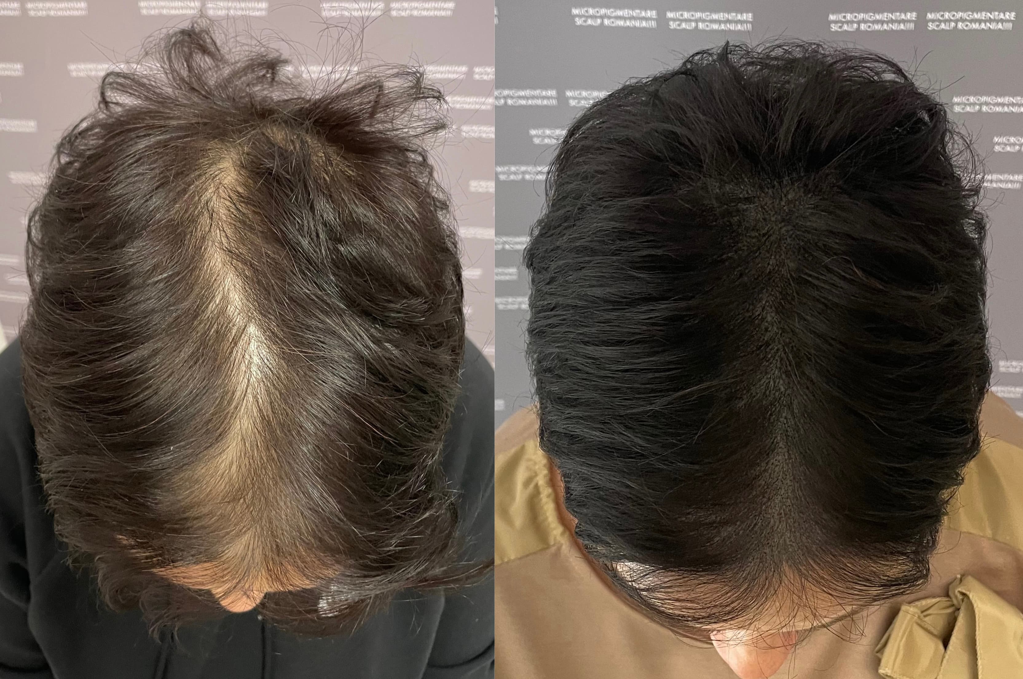 Perspectivă micropigmentare scalp - Micropigmentare Scalp Femei