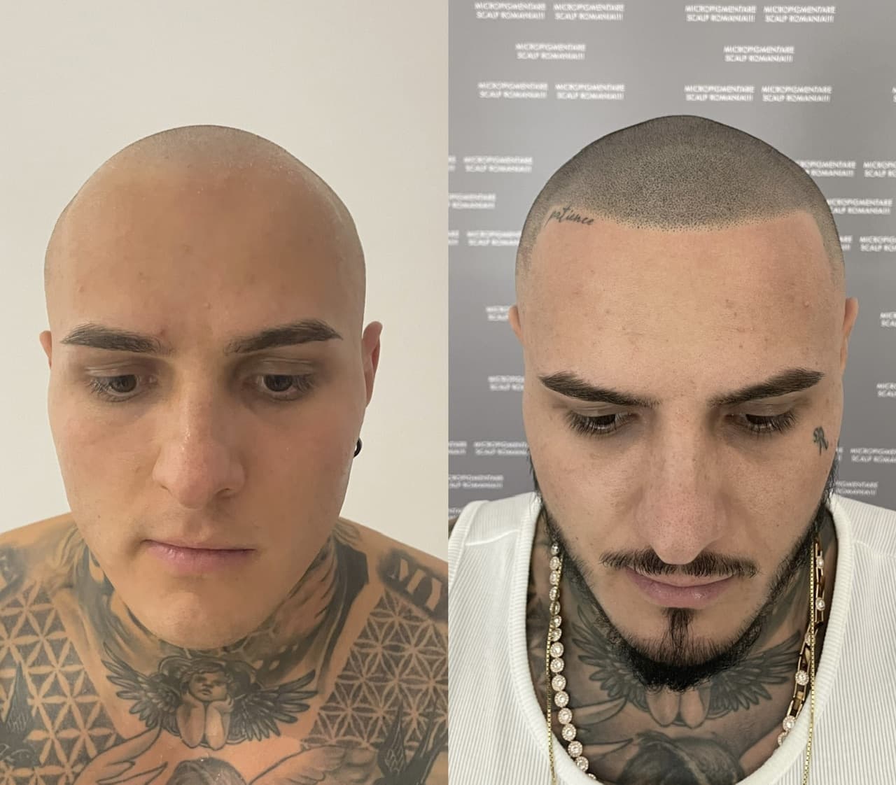 Perspectivă micropigmentare scalp - Densitate Post Transplant