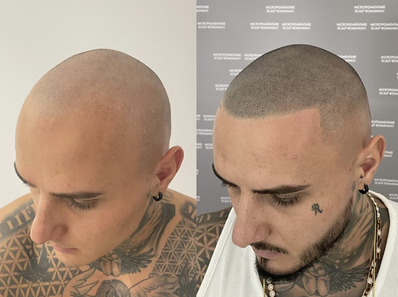 Perspectivă micropigmentare scalp - Densitate Post Transplant