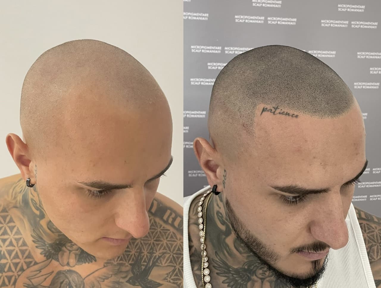 Perspectivă micropigmentare scalp - Densitate Post Transplant