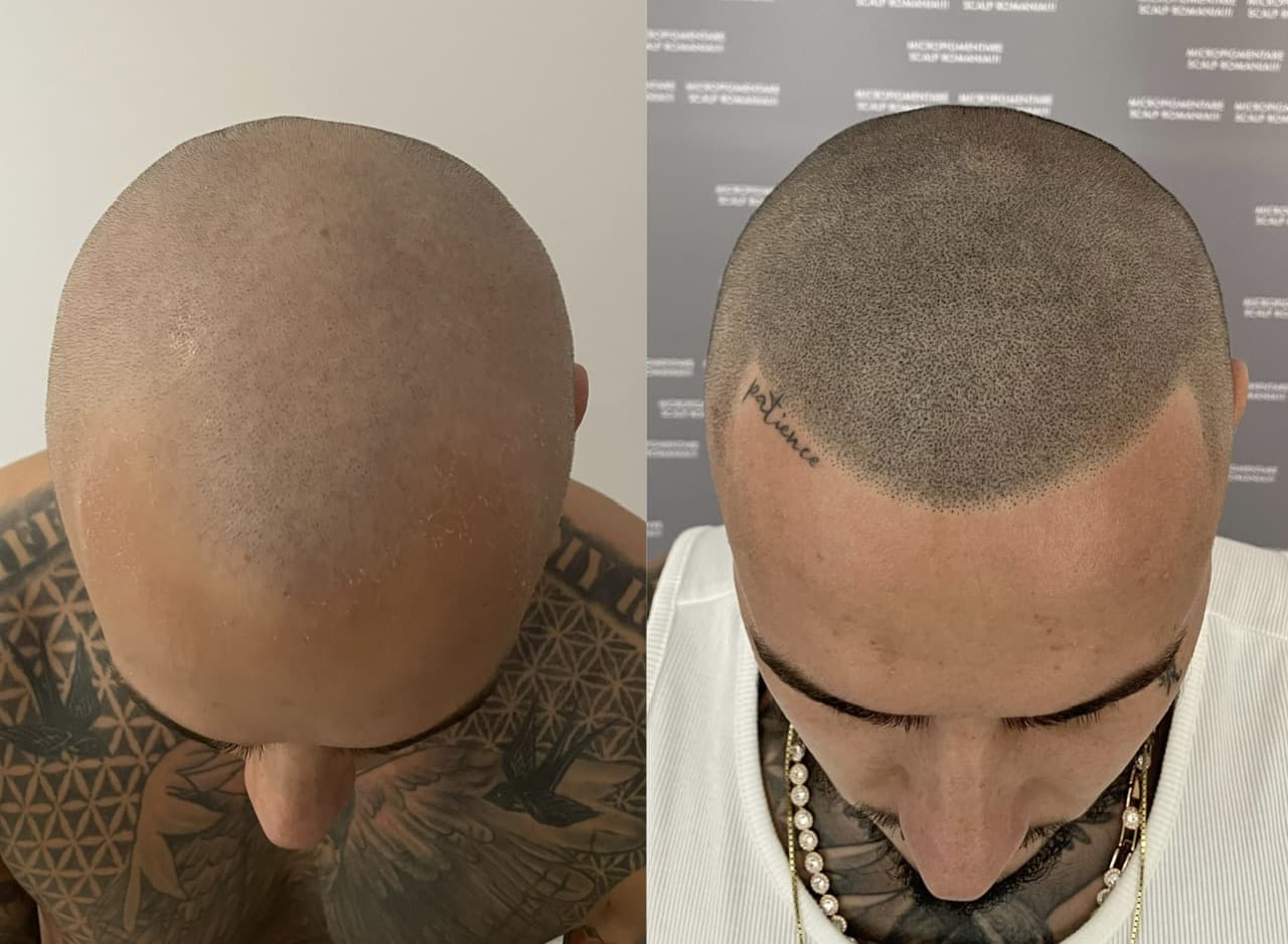Perspectivă micropigmentare scalp - Densitate Post Transplant