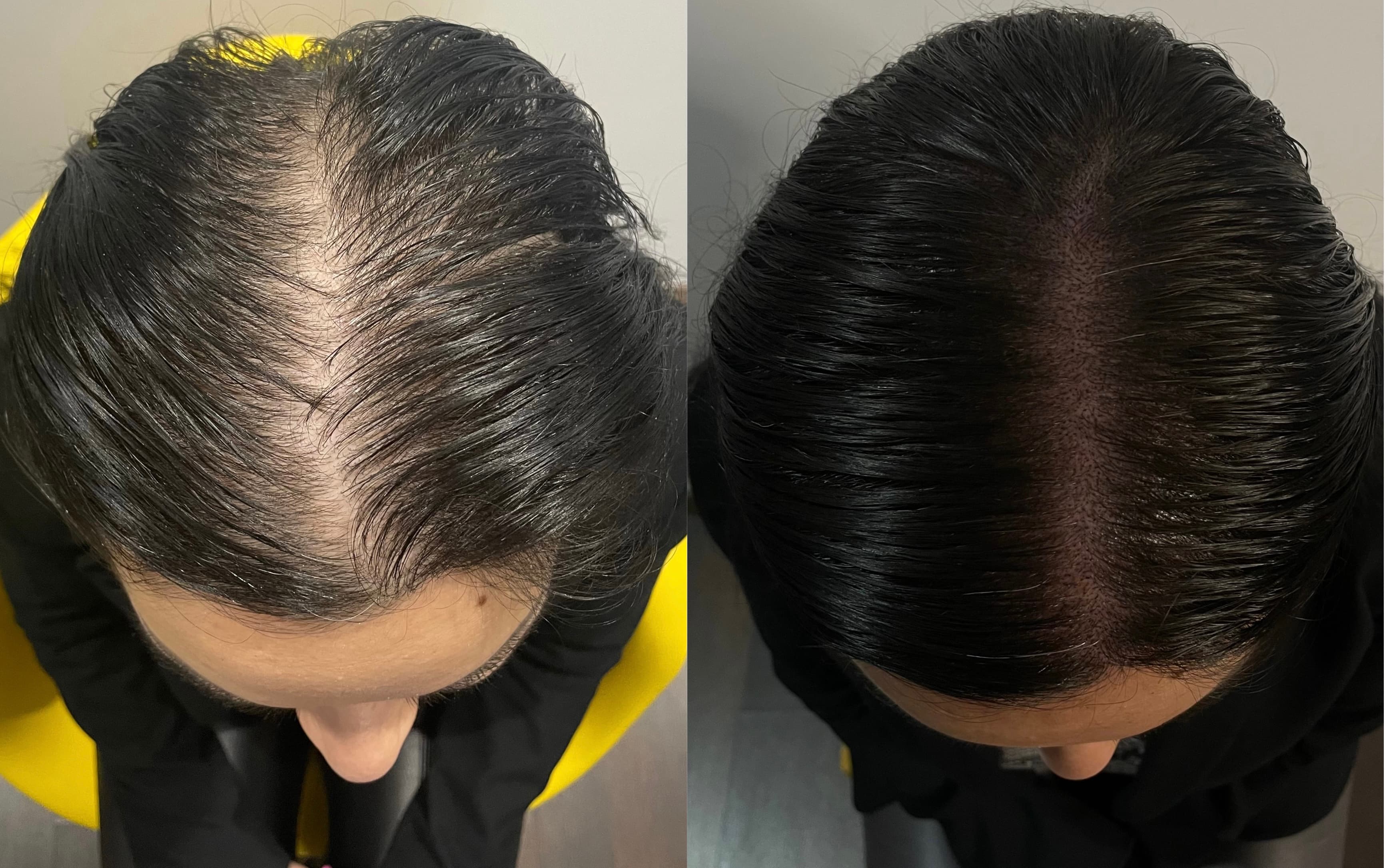 Perspectivă micropigmentare scalp - Micropigmentare Scalp Femei