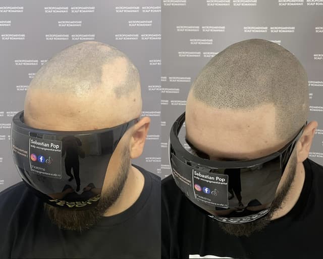 Perspectivă micropigmentare scalp - Alopecie Areată