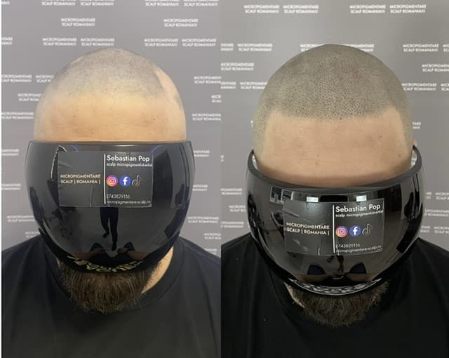 Perspectivă micropigmentare scalp - Alopecie Areată