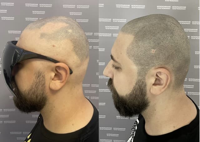Perspectivă micropigmentare scalp - Alopecie Areată