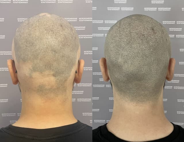 Perspectivă micropigmentare scalp - Alopecie Areată